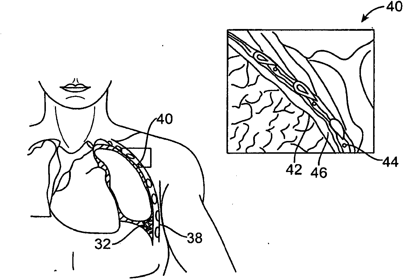 Cross-sectional modification during deployment of an elongate lung volume reduction device