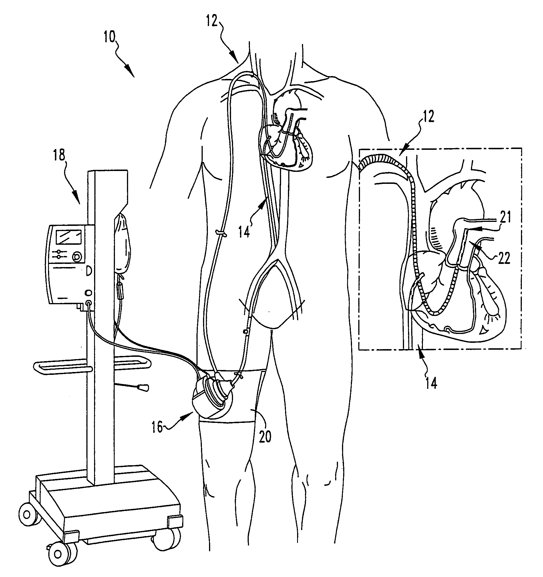 Percutaneous right ventricular assist apparatus and method
