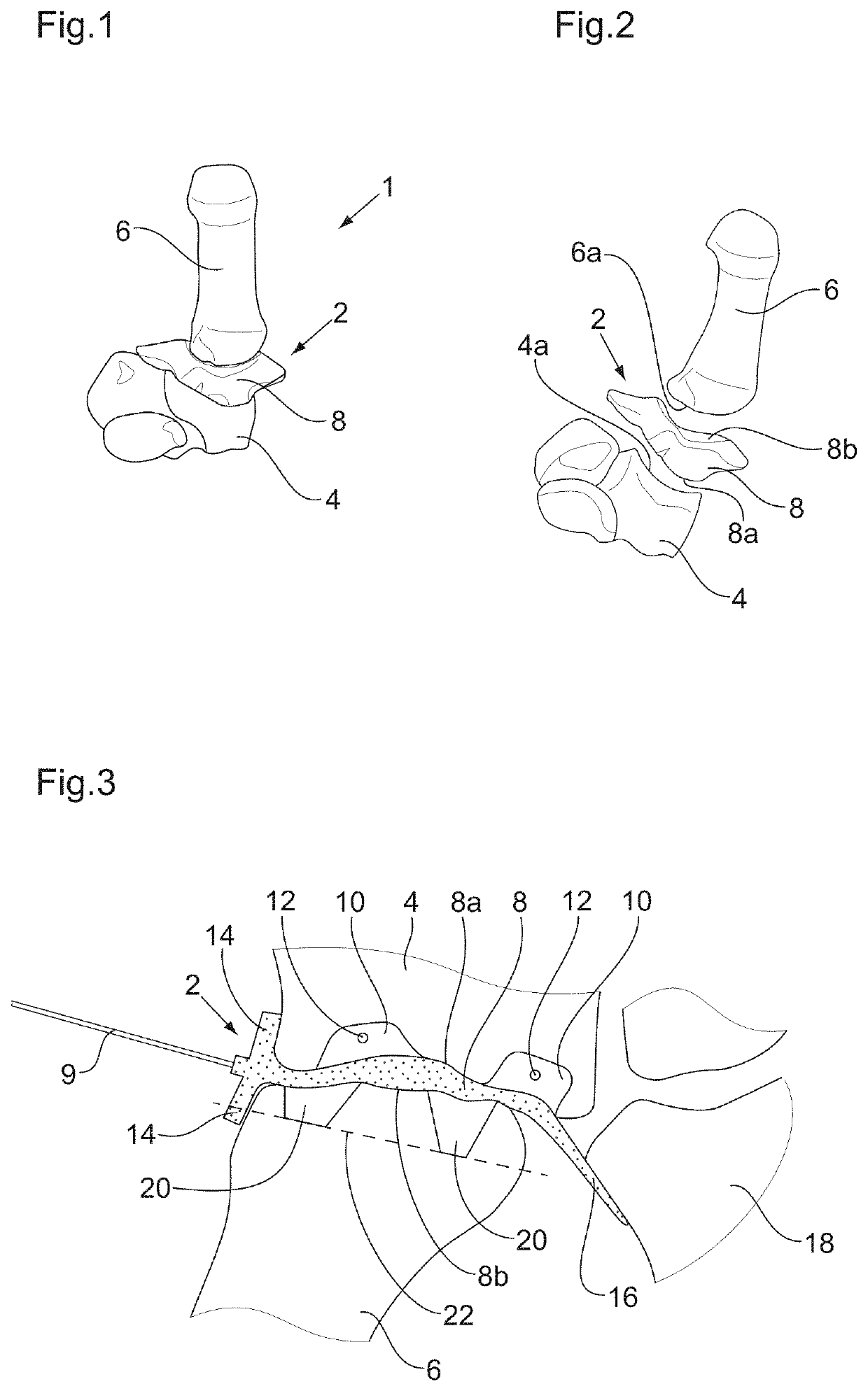 Device for assisting in the placement of a trapeziometacarpal prosthesis