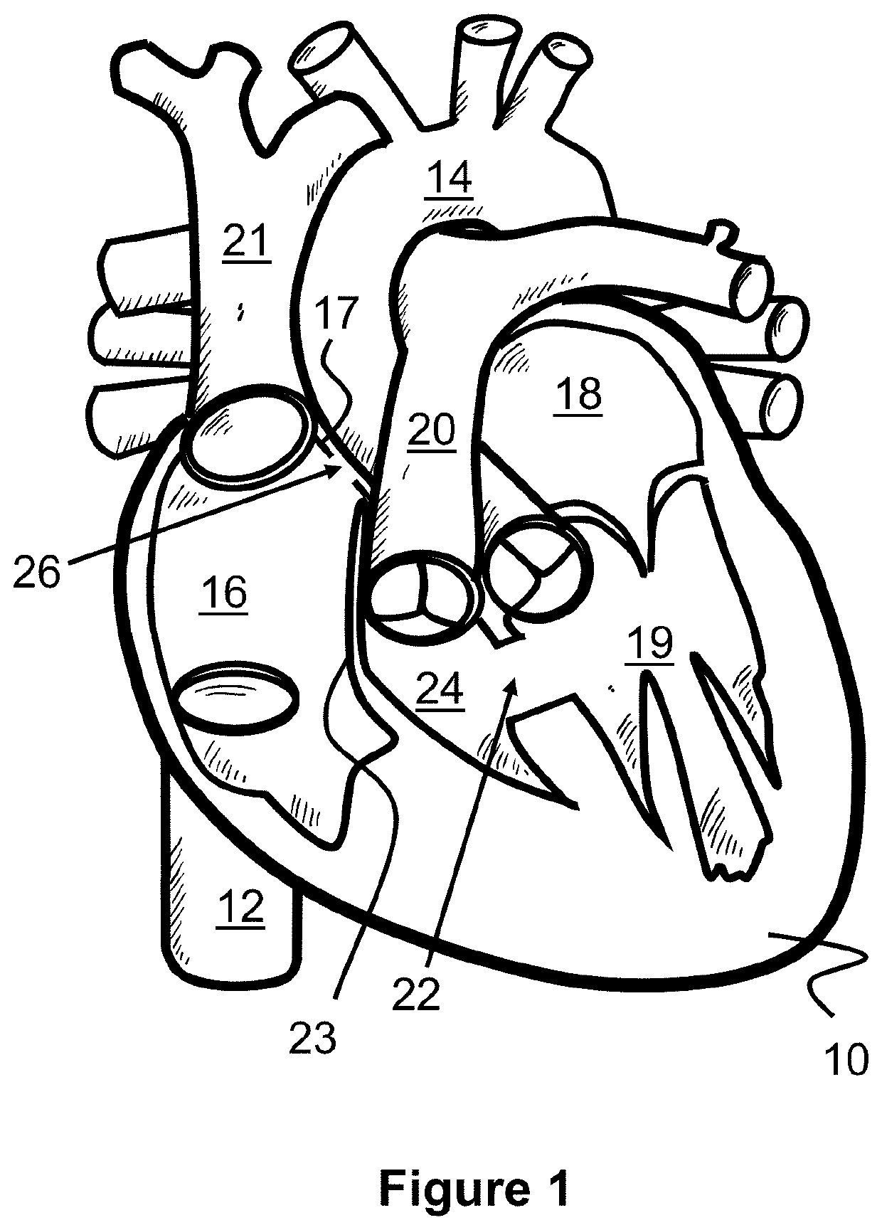 Method For Bypassing Defective Portions Of A Heart