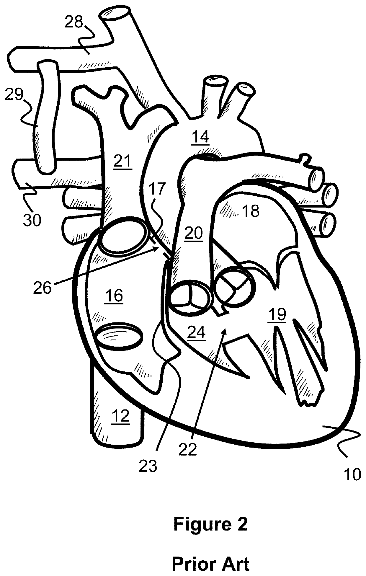 Method For Bypassing Defective Portions Of A Heart