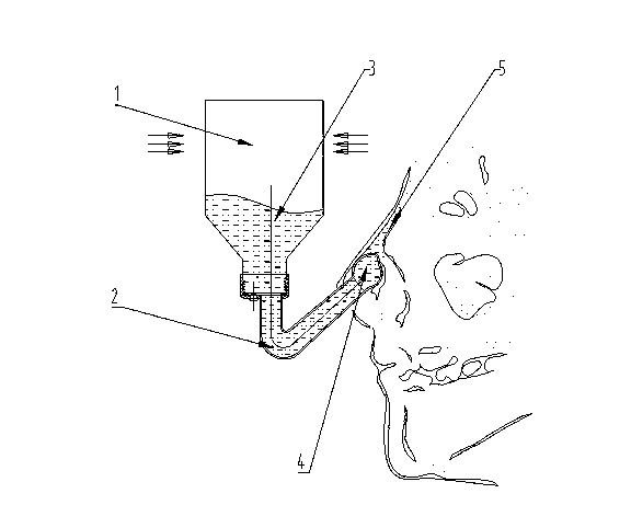 Nasal irrigator built in nasal vestibule