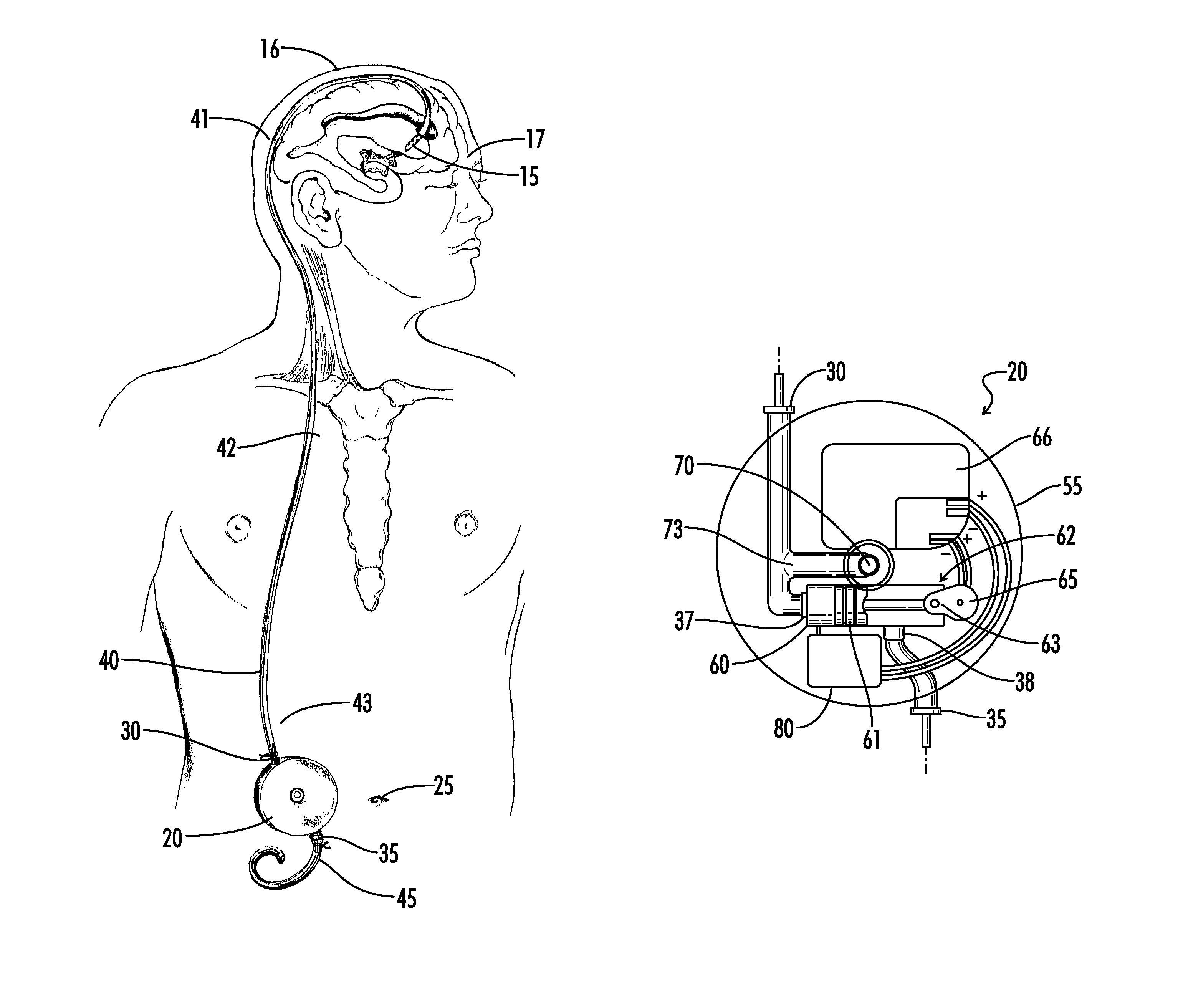Implantable pump for removal of cerebrospinal fluid