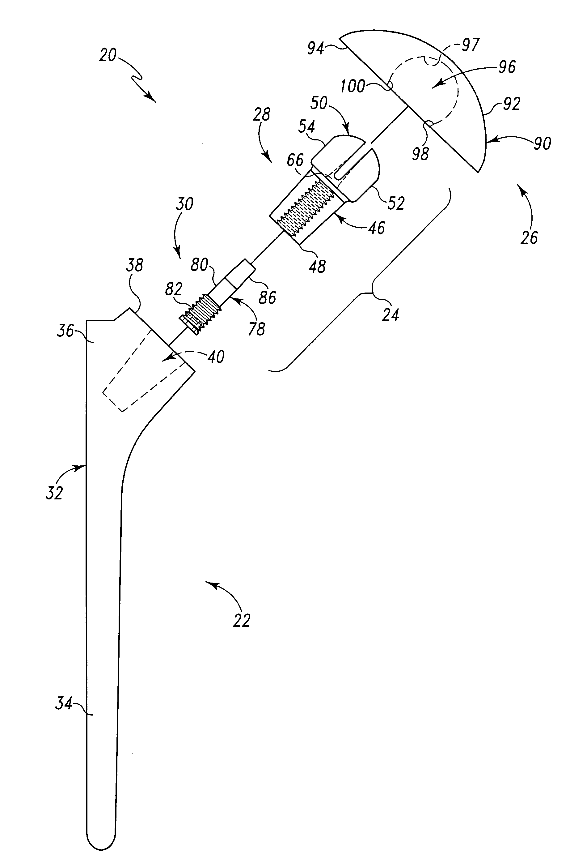 Shoulder prosthesis having infinitely adjustable humeral head