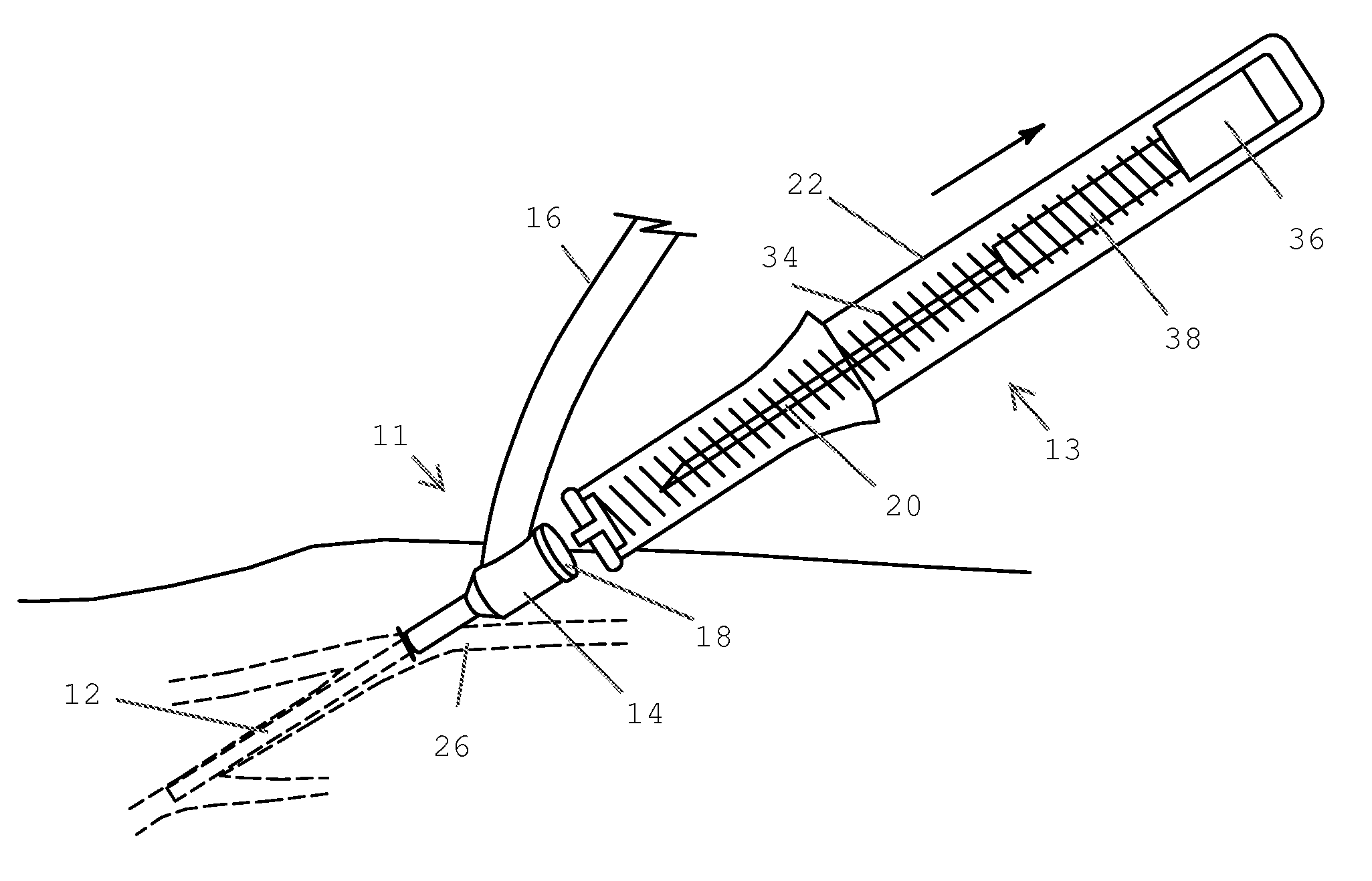 Angiocatheter and method of operating the same