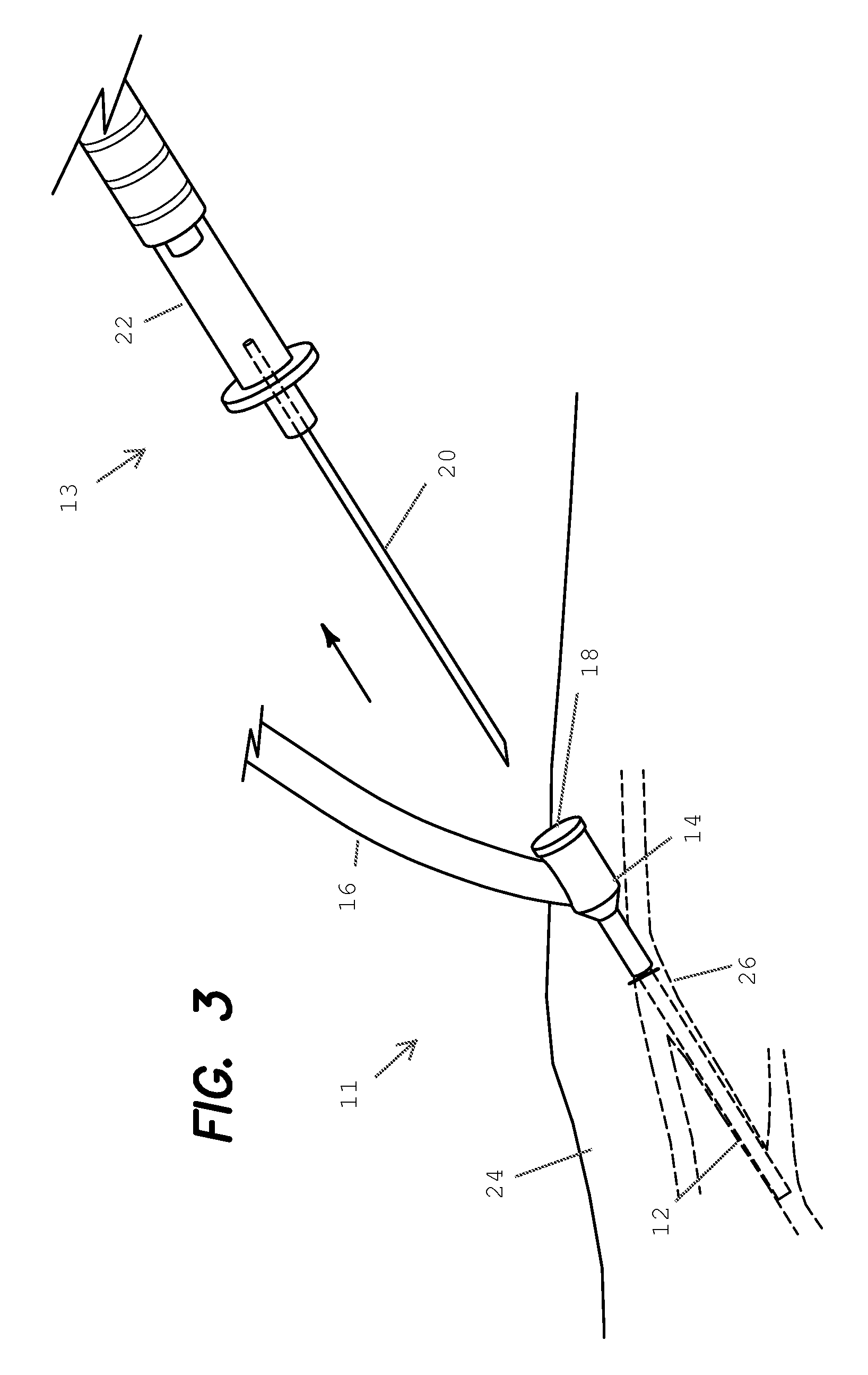 Angiocatheter and method of operating the same