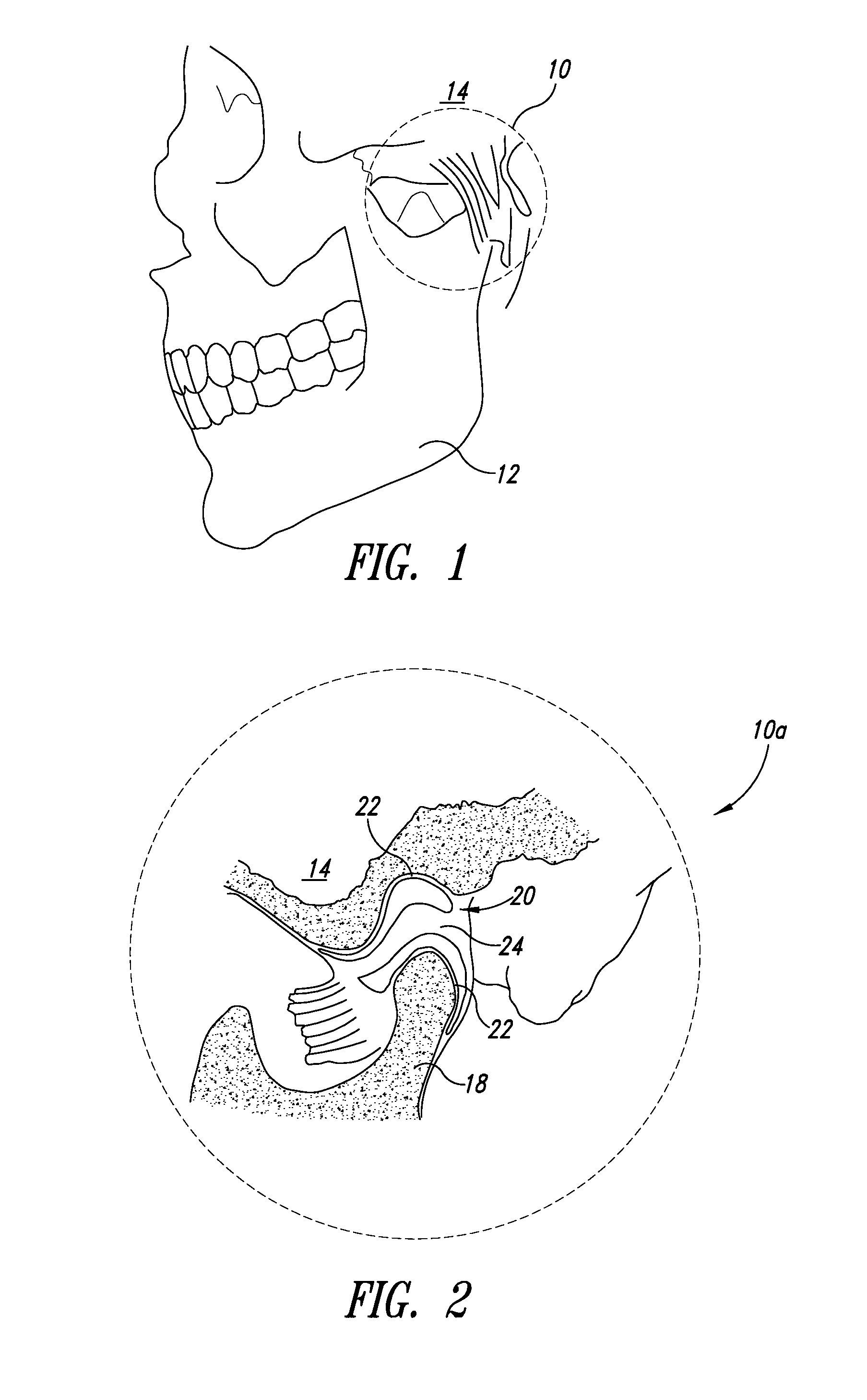 Systems, apparatuses, and methods for providing non-transcranial electrotherapy