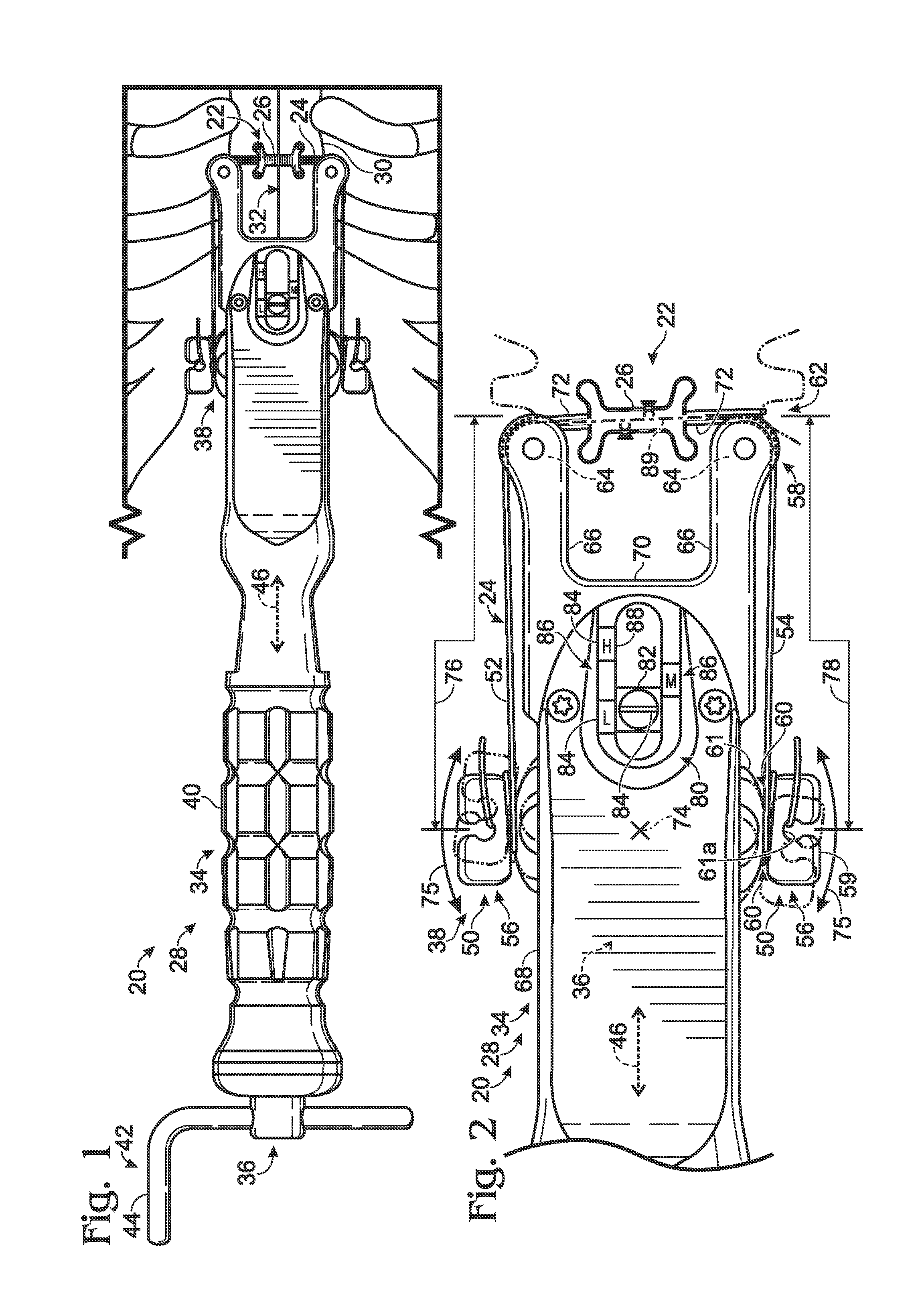 System for tensioning a surgical wire