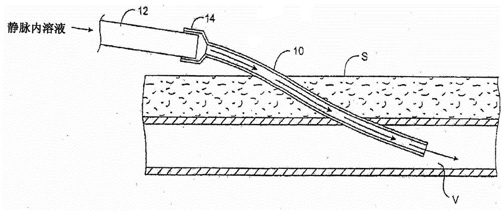 Transdermal venous access locking solutions