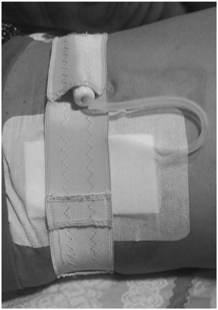 Skin fitting device for peritoneal dialysis in nephrology department
