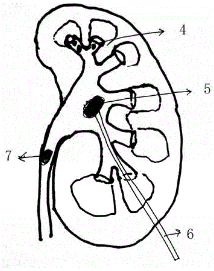 Adjustable percutaneous renal operation sheath