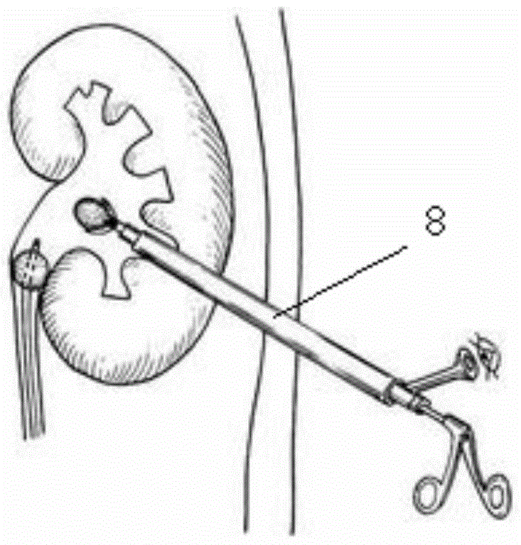 Adjustable percutaneous renal operation sheath