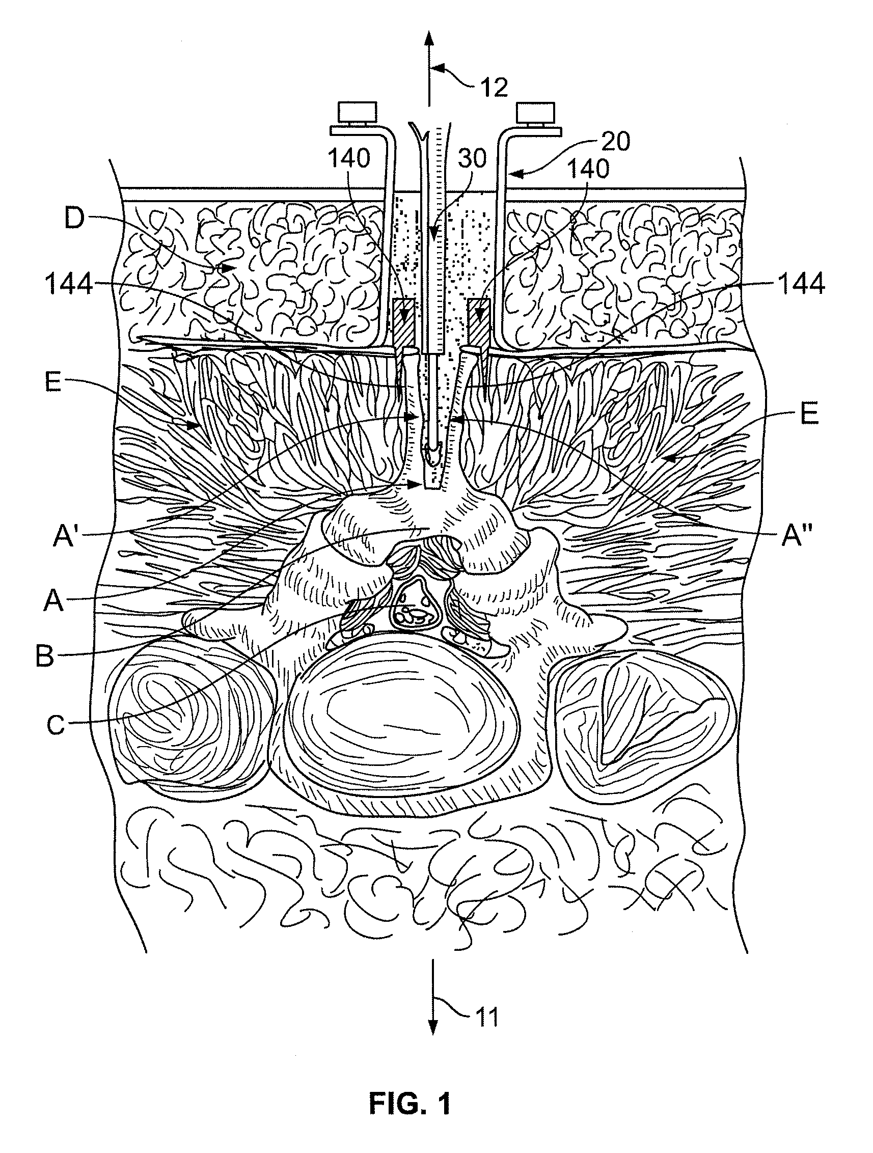 System and Method for Centering Surgical Cutting Tools About the Spinous Process or Other Bone Structure
