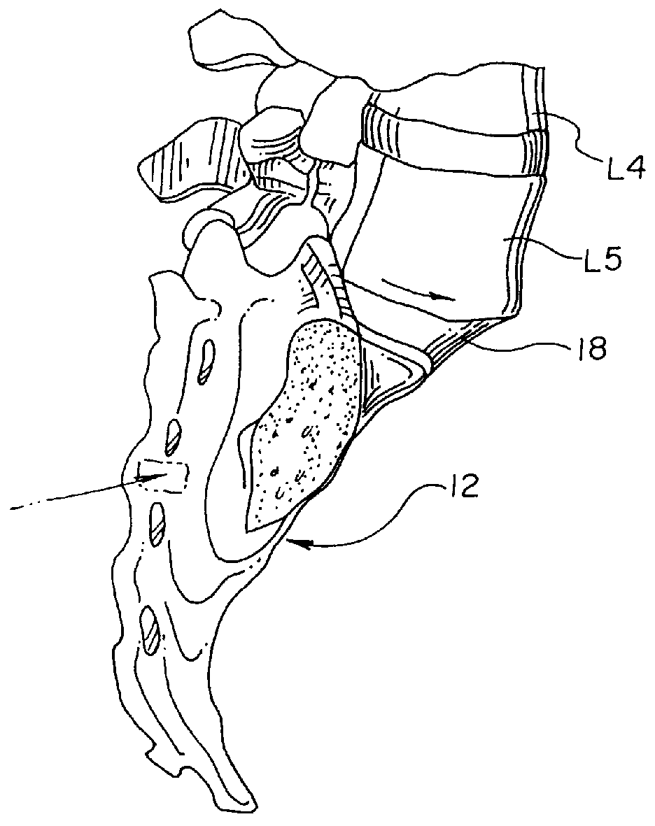 Method and device for fixing spondylolisthesis posteriorly