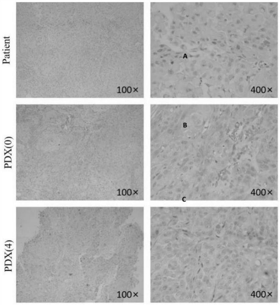 Method for researching antineoplastic effect of apatinib based on PDX model