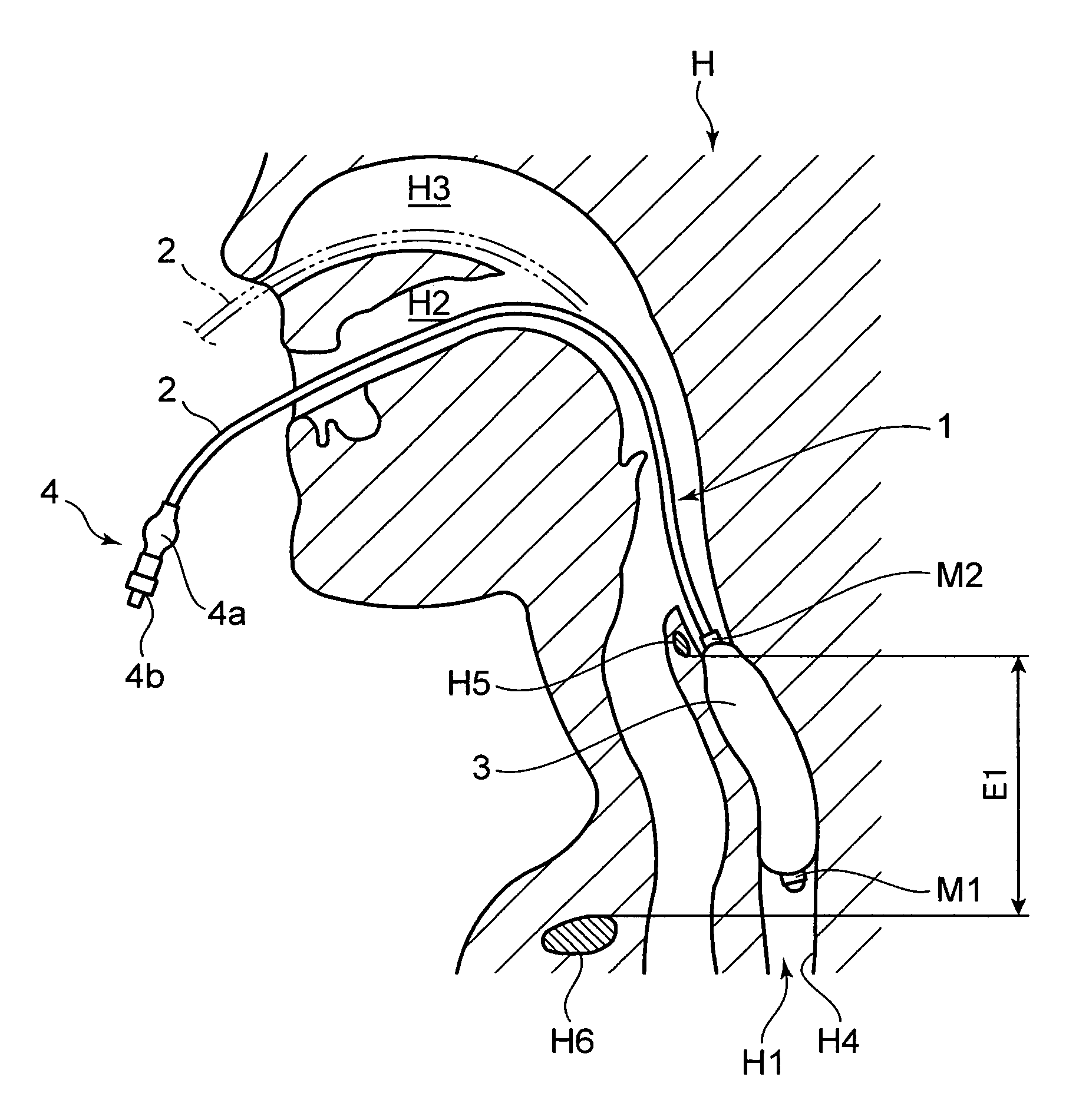 Brain cooling device and brain cooling system comprising the device