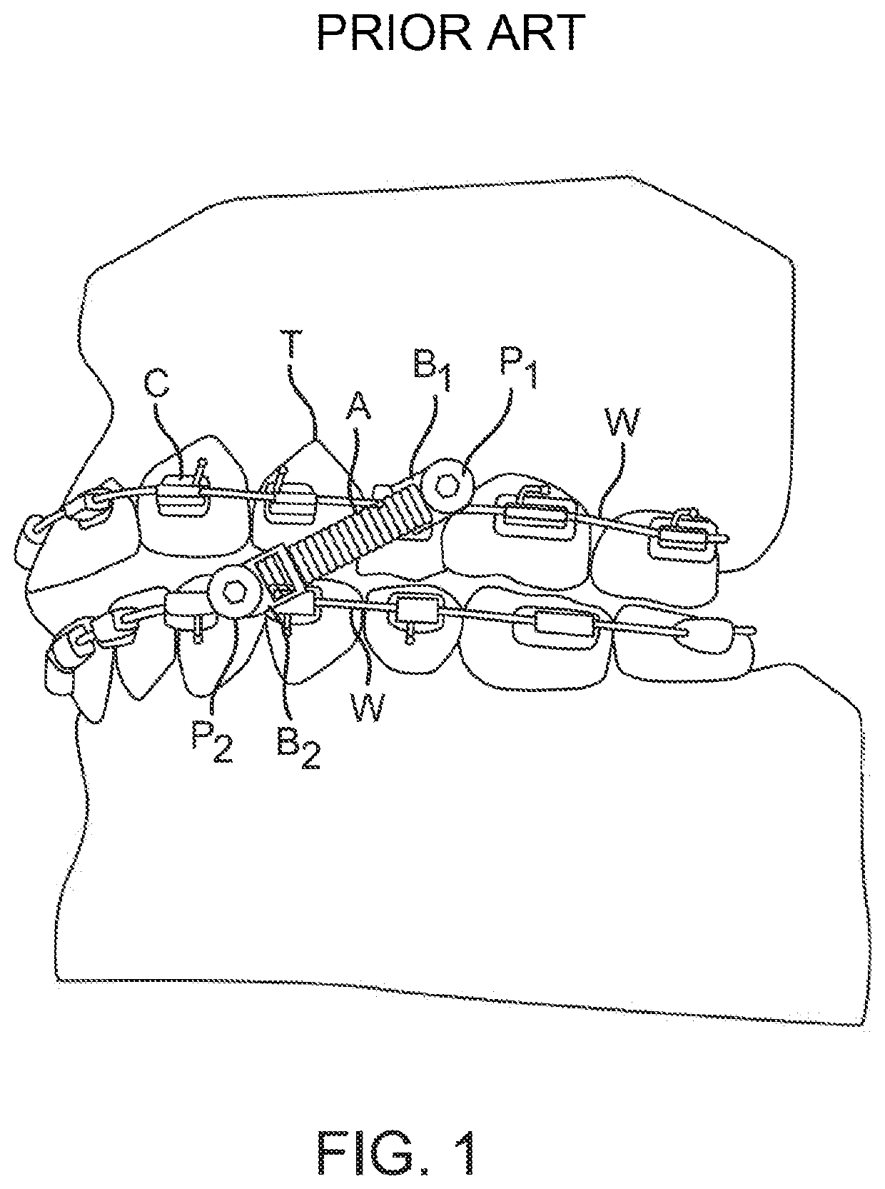 Twist-lock orthodontic post