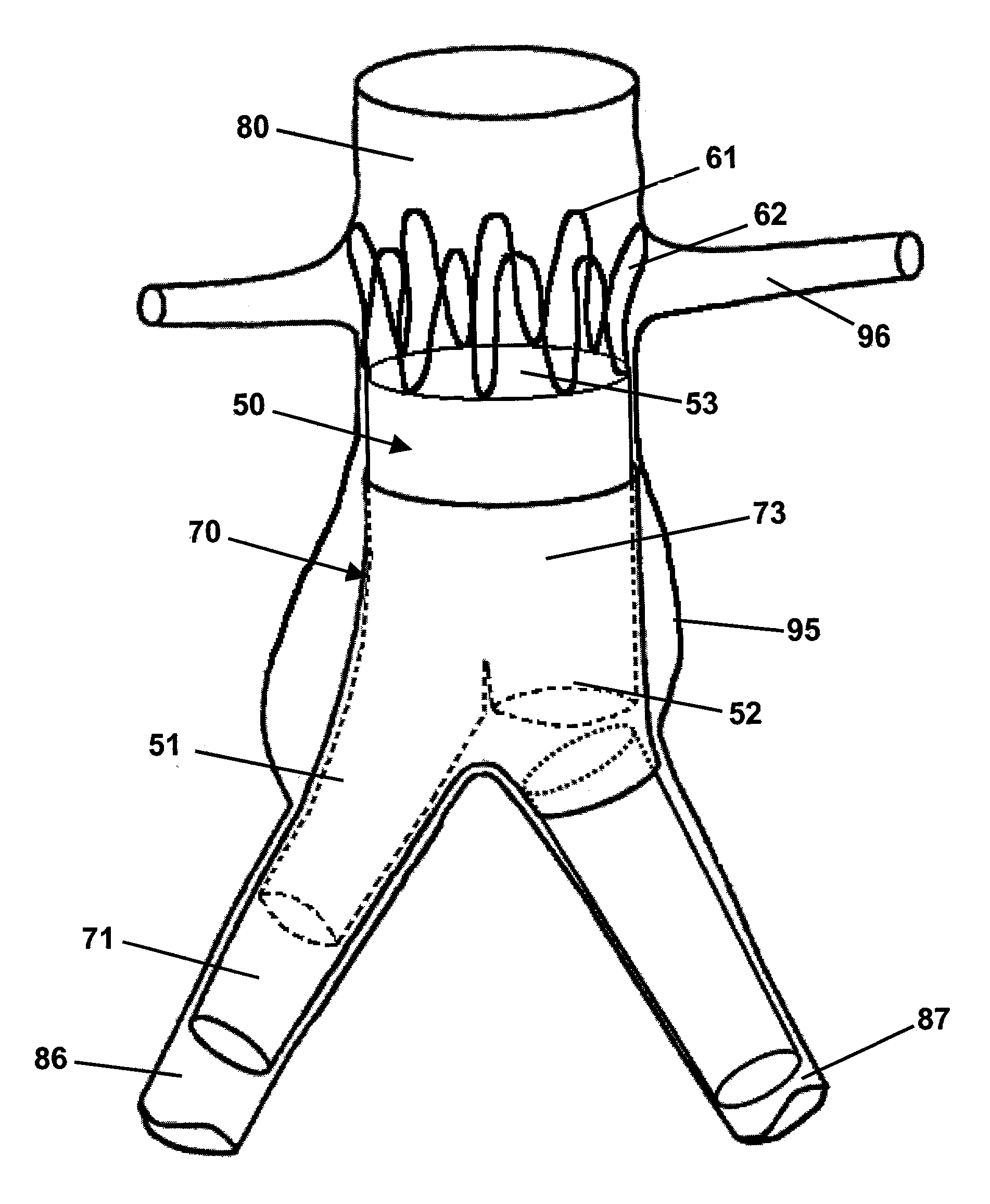 Endoluminal prosthetic assembly and extension method