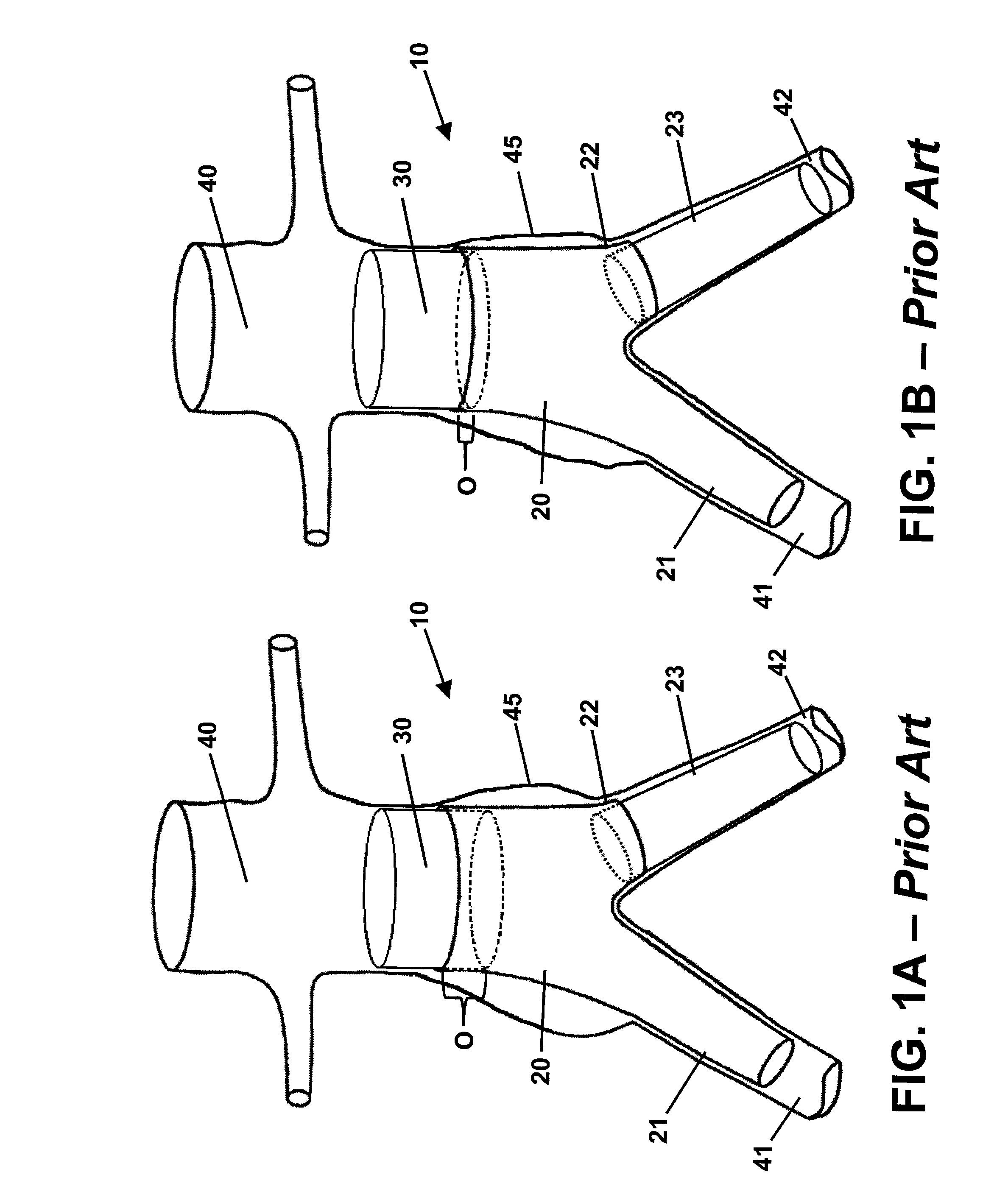 Endoluminal prosthetic assembly and extension method
