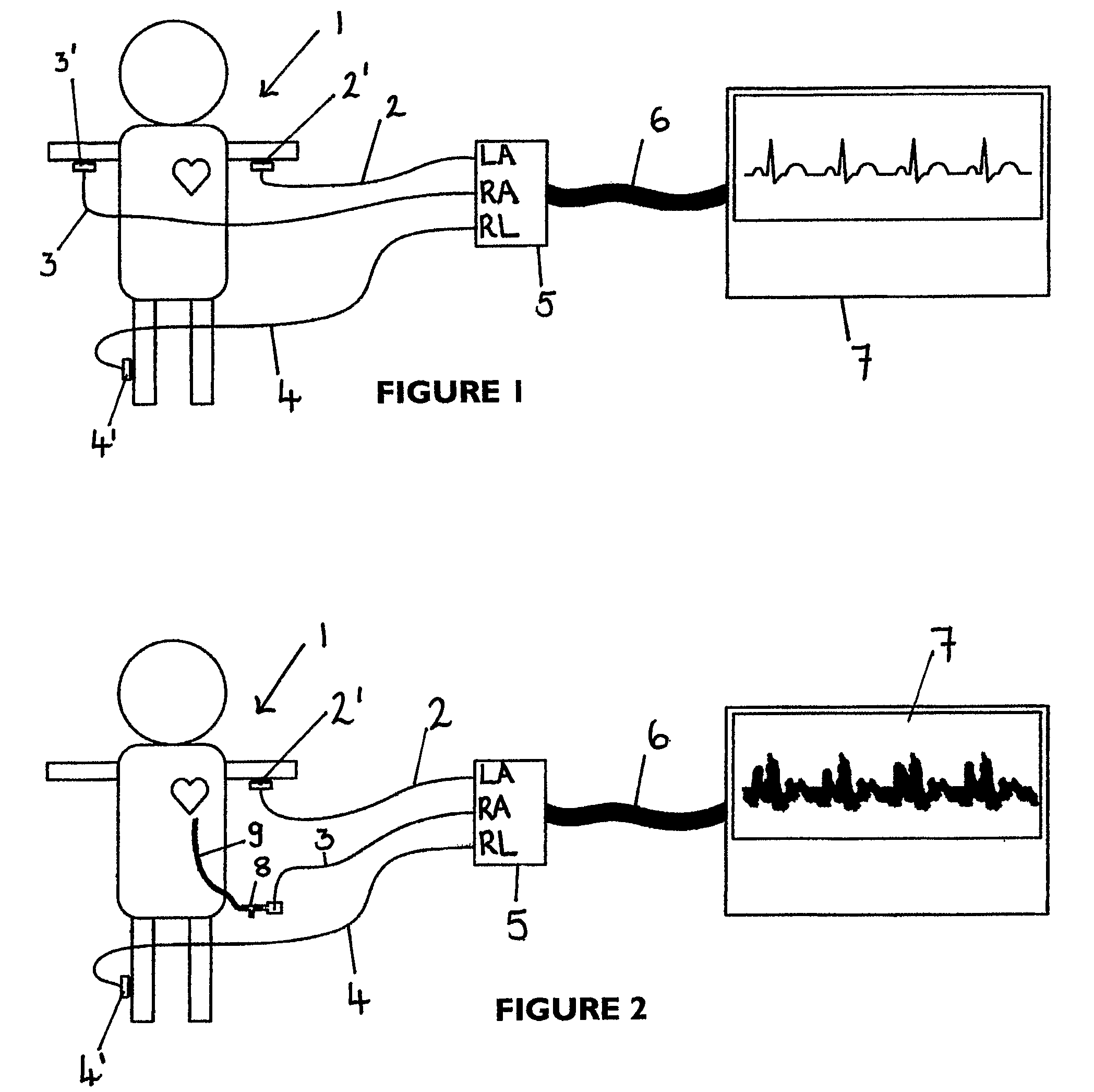 Apparatus for detecting the position of a percutaneously-inserted intravenous catheter