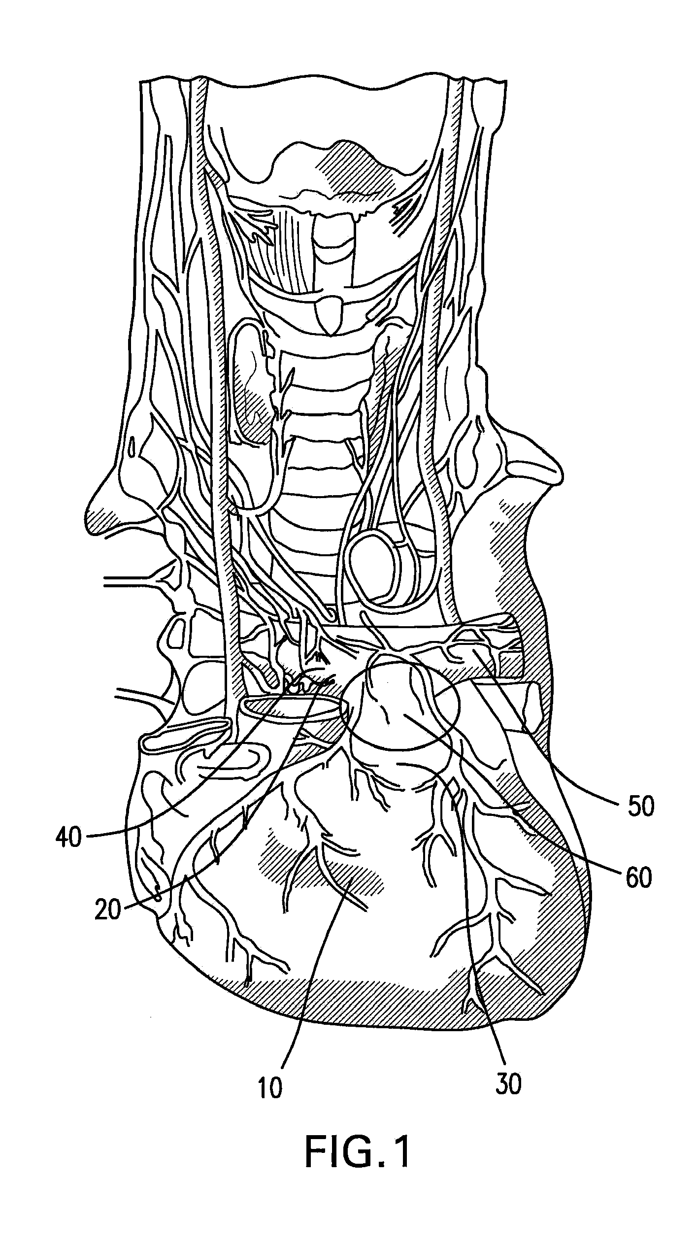 Method and System for Treating Acute Heart Failure by Neuromodulation