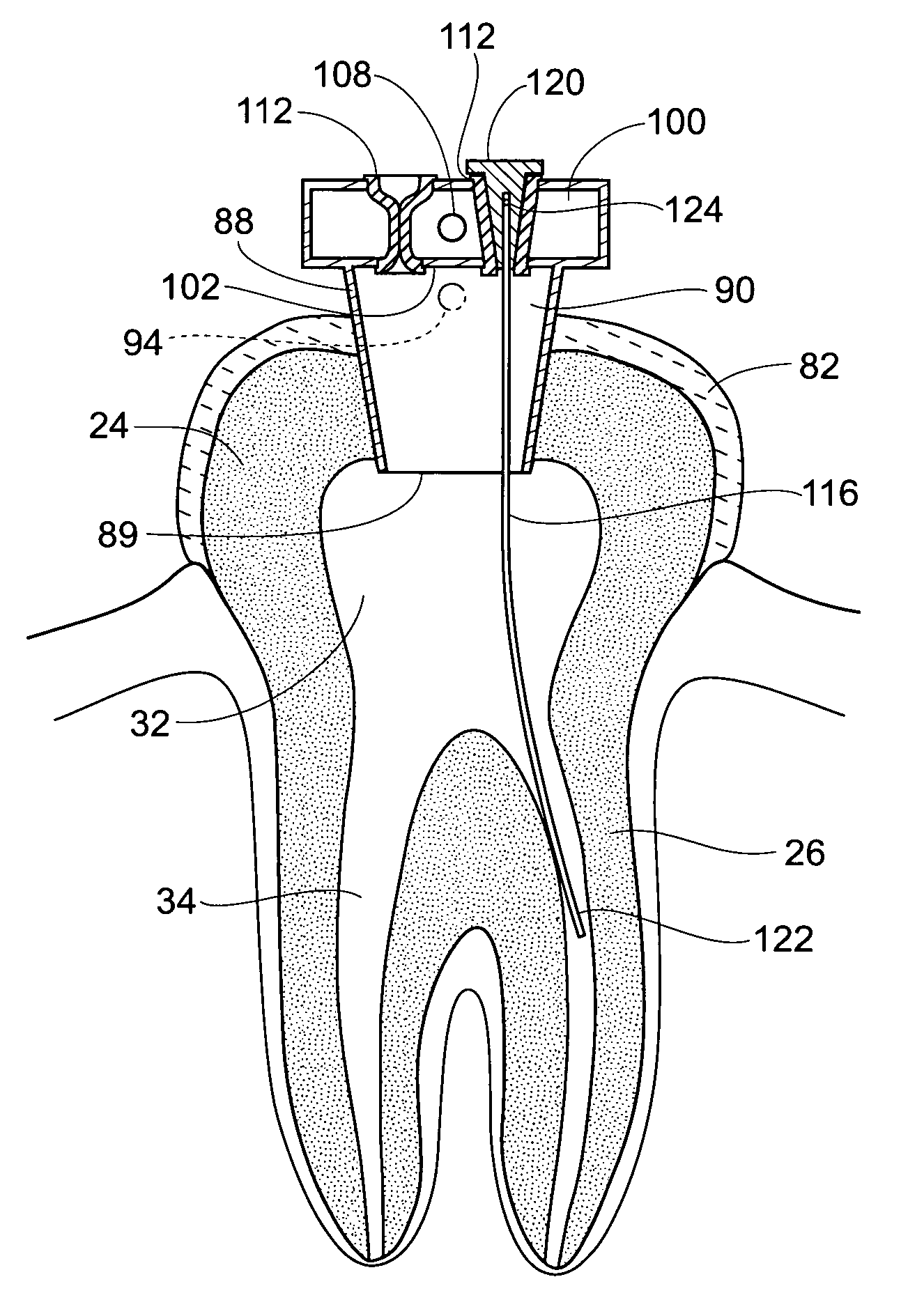 Apparatus and methods for treating tooth root canals