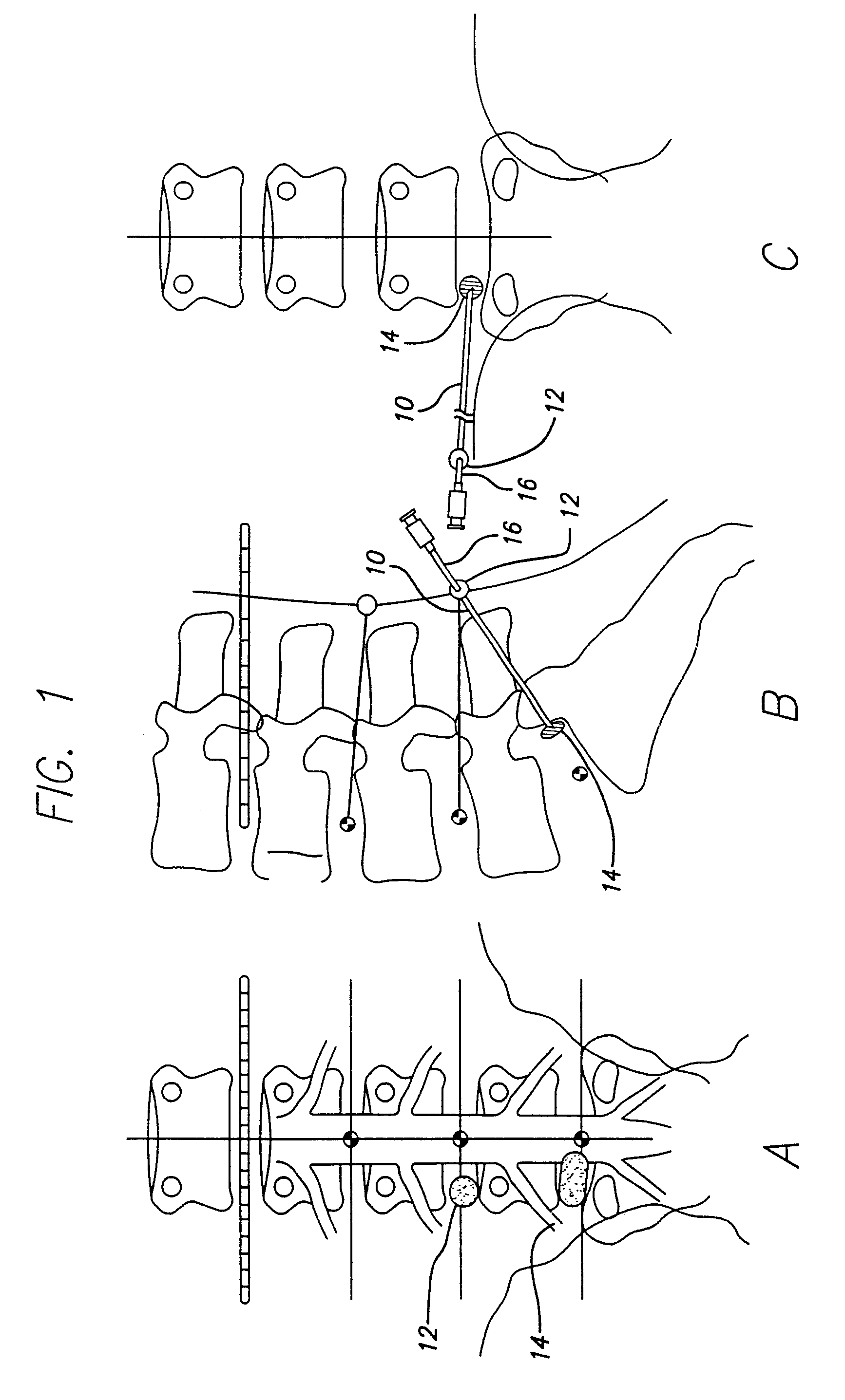 Method and apparatus for endoscopic spinal surgery