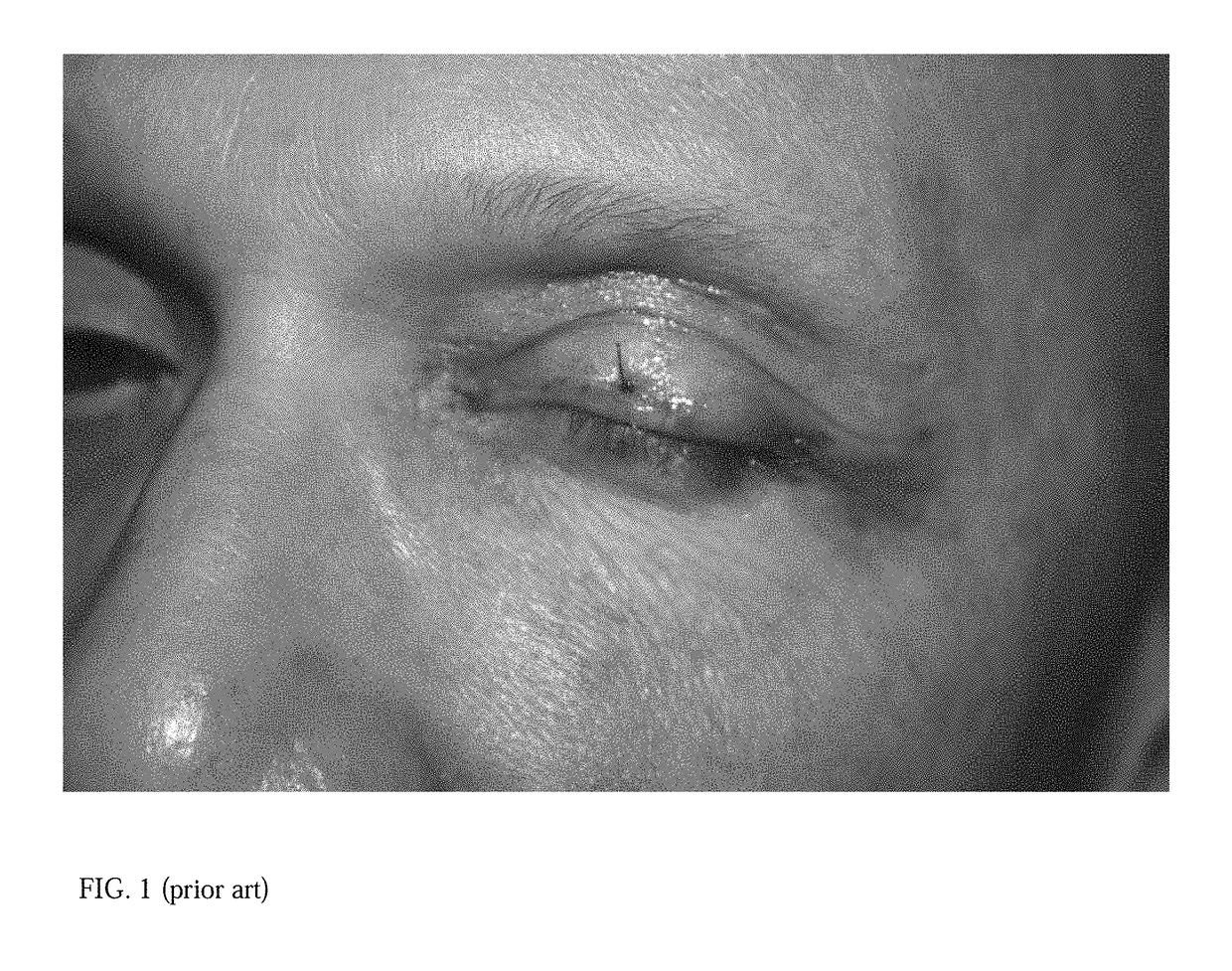 Tarsus eyelid patch