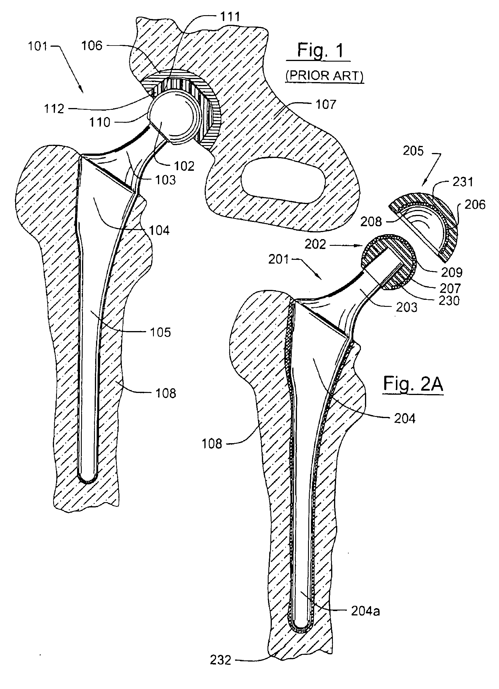 Prosthetic knee joint having at least one diamond articulation surface