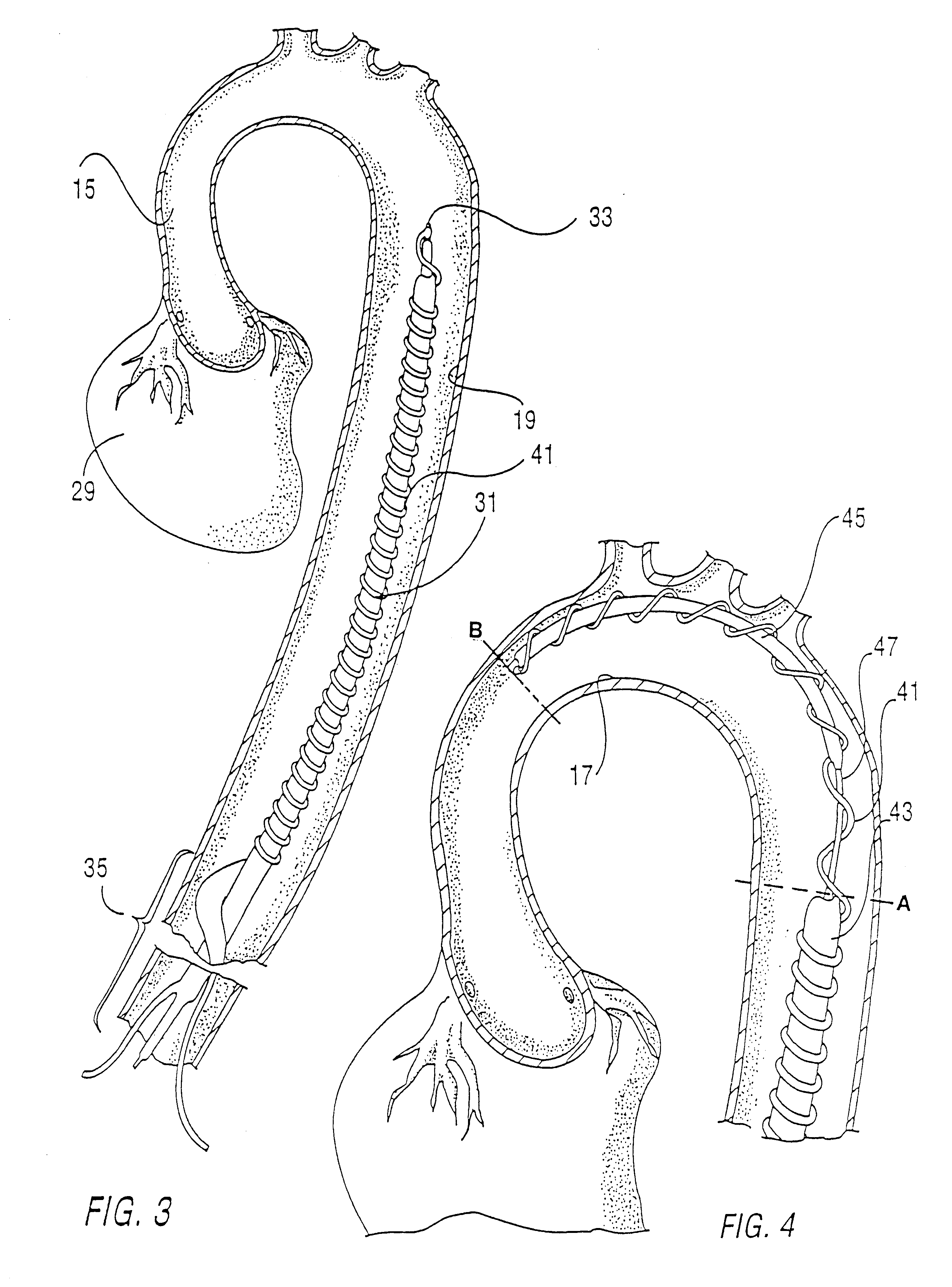 Removable left ventricular assist device with an aortic support apparatus