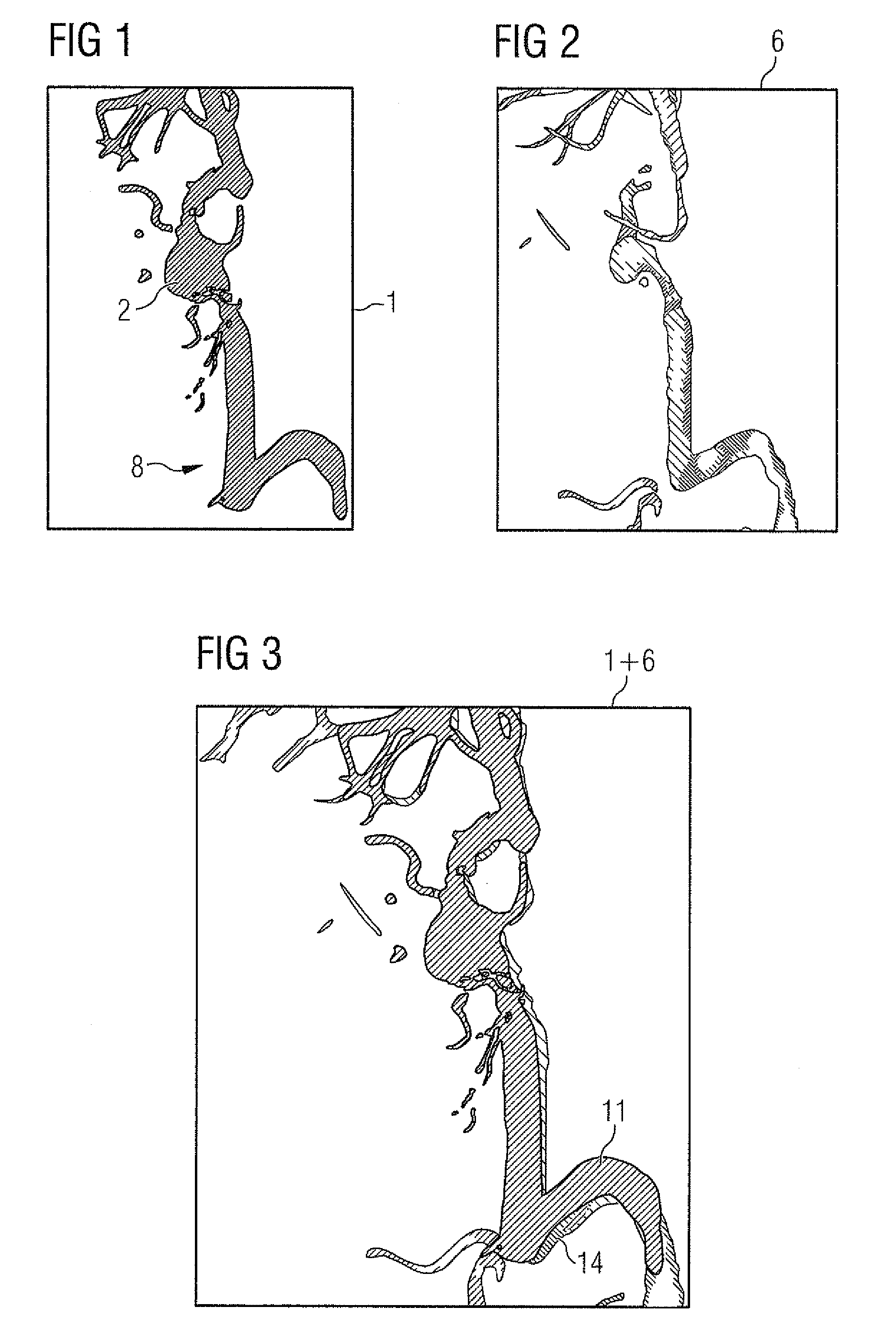 Method for post-processing a three-dimensional image data set of vessel structure