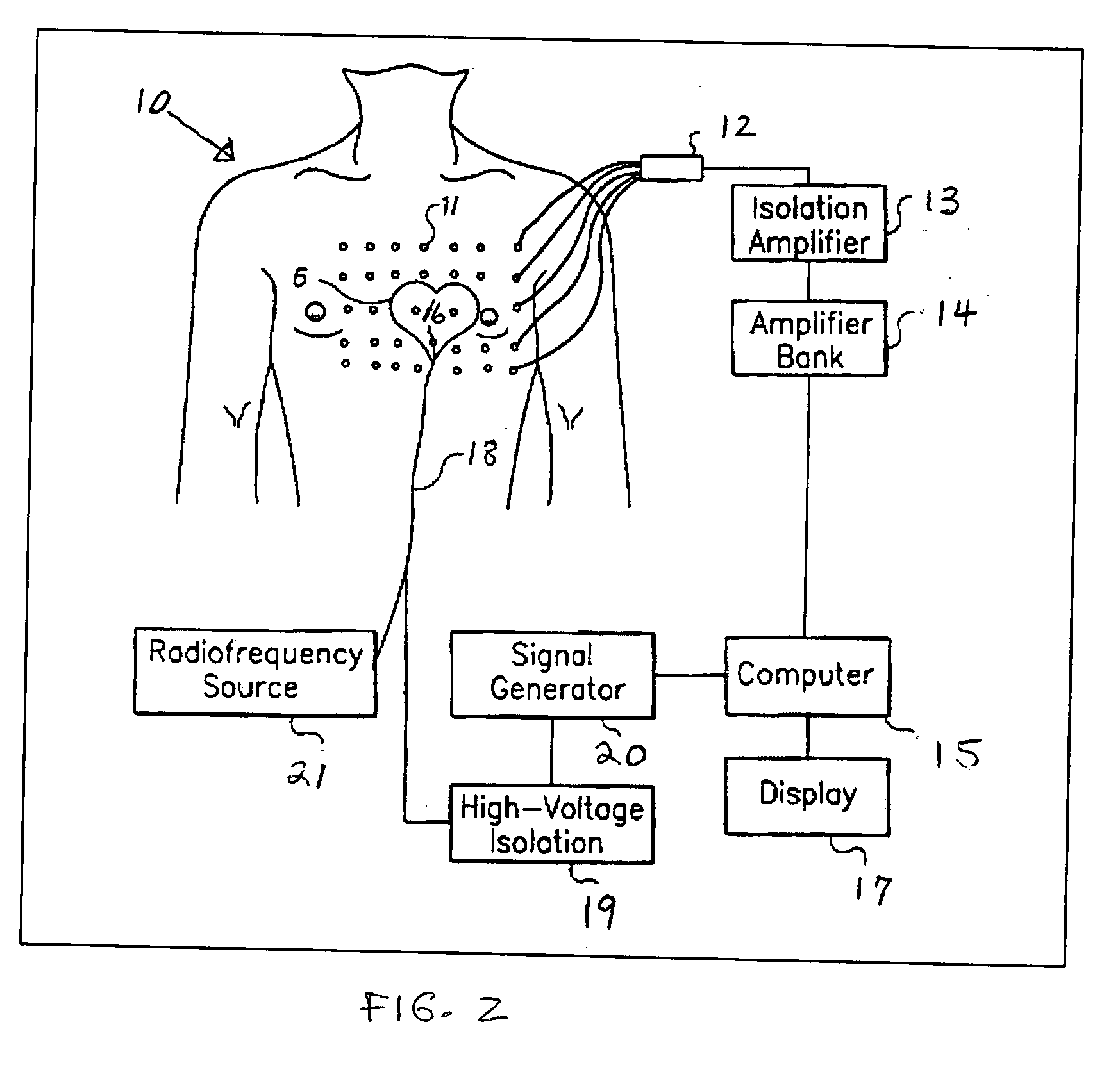 Method and apparatus for the guided ablative therapy of fast ventricular arrhythmia