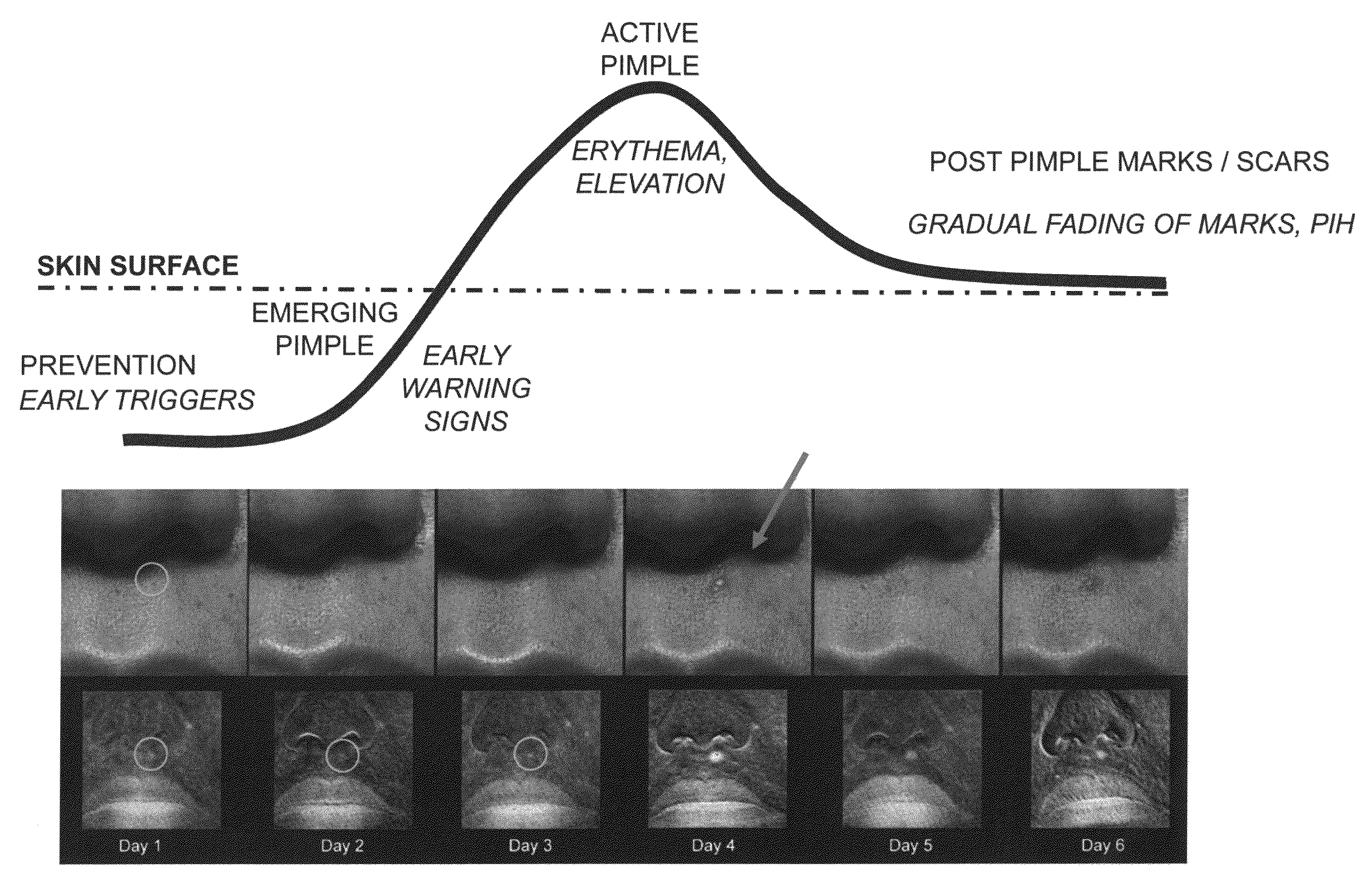 Method for demonstrating pre-emergent pimples