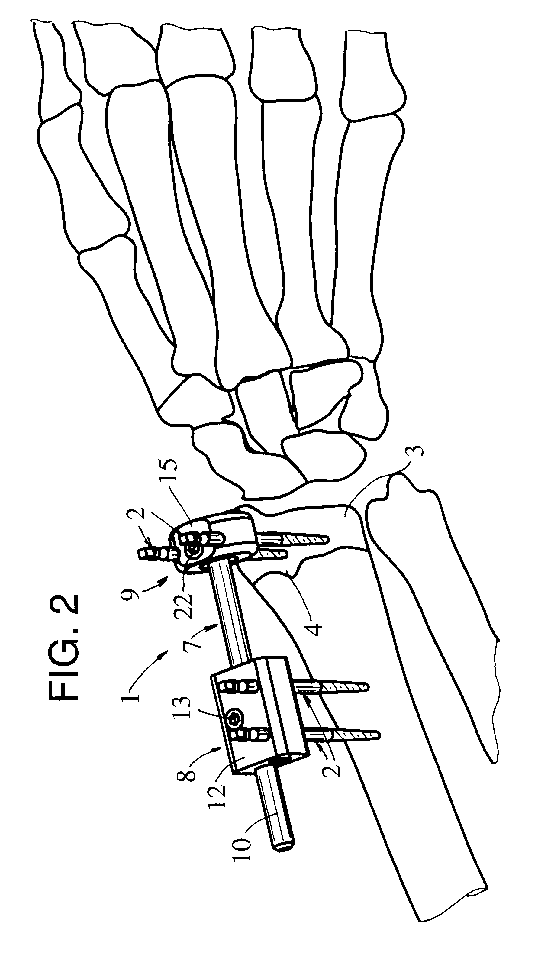 External fixator for immobilizing bone fragments, particularly in the area of the wrist