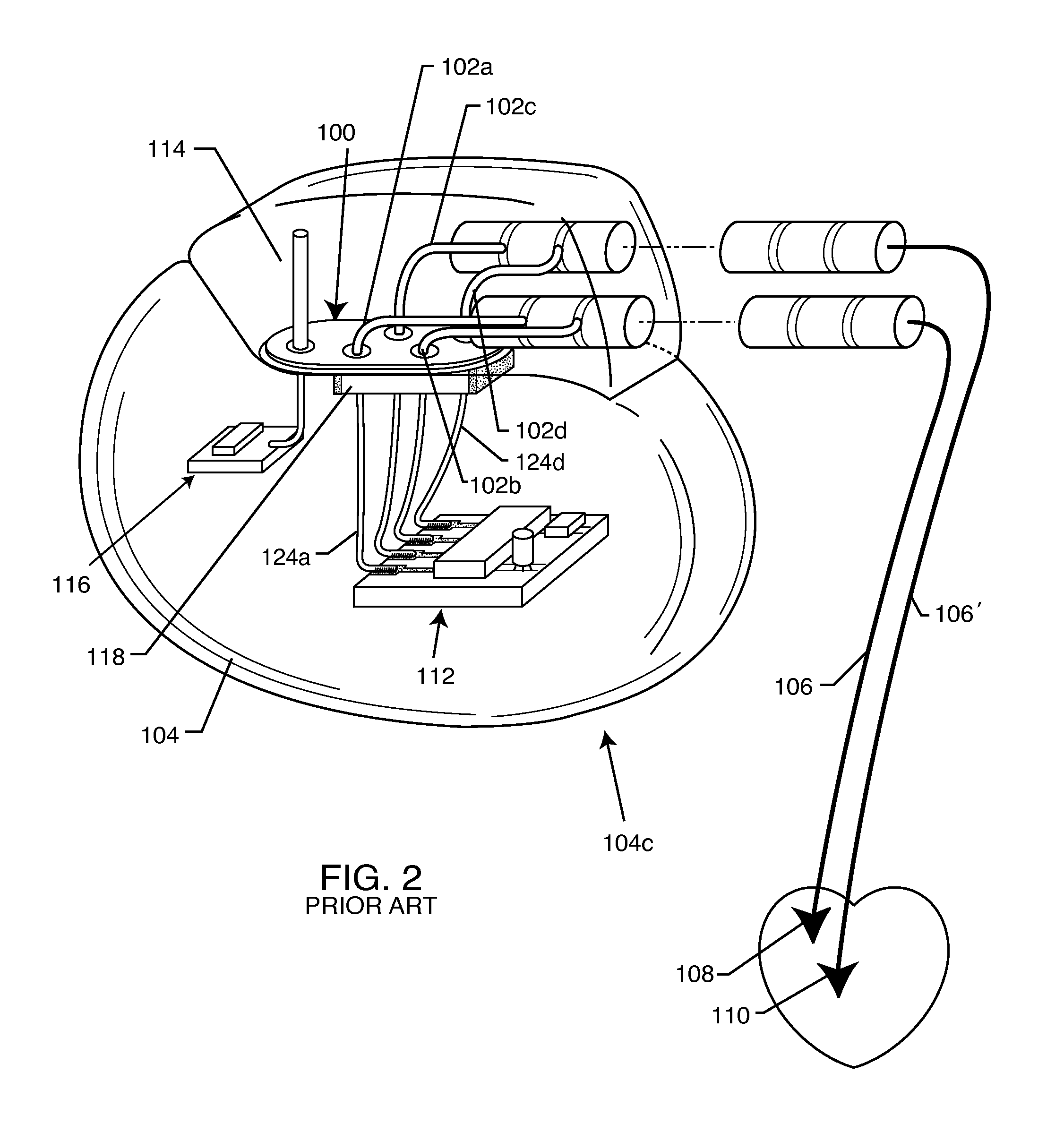 EMI shielded conduit assembly for an active implantable medical device