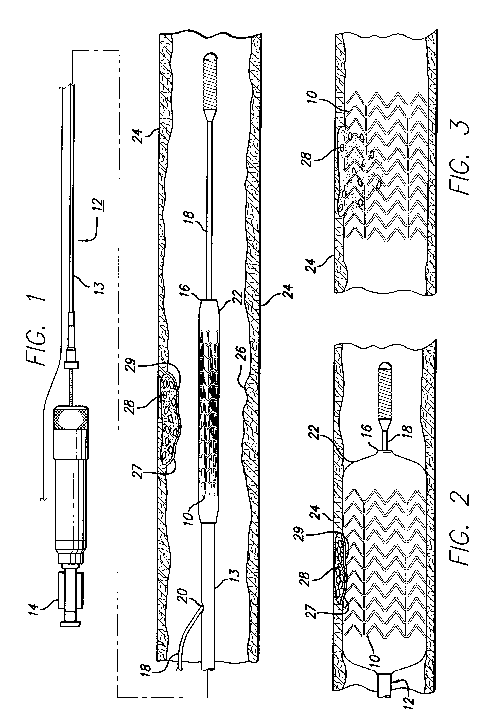 Intravascular stent for treating vulnerable plaque and method of use