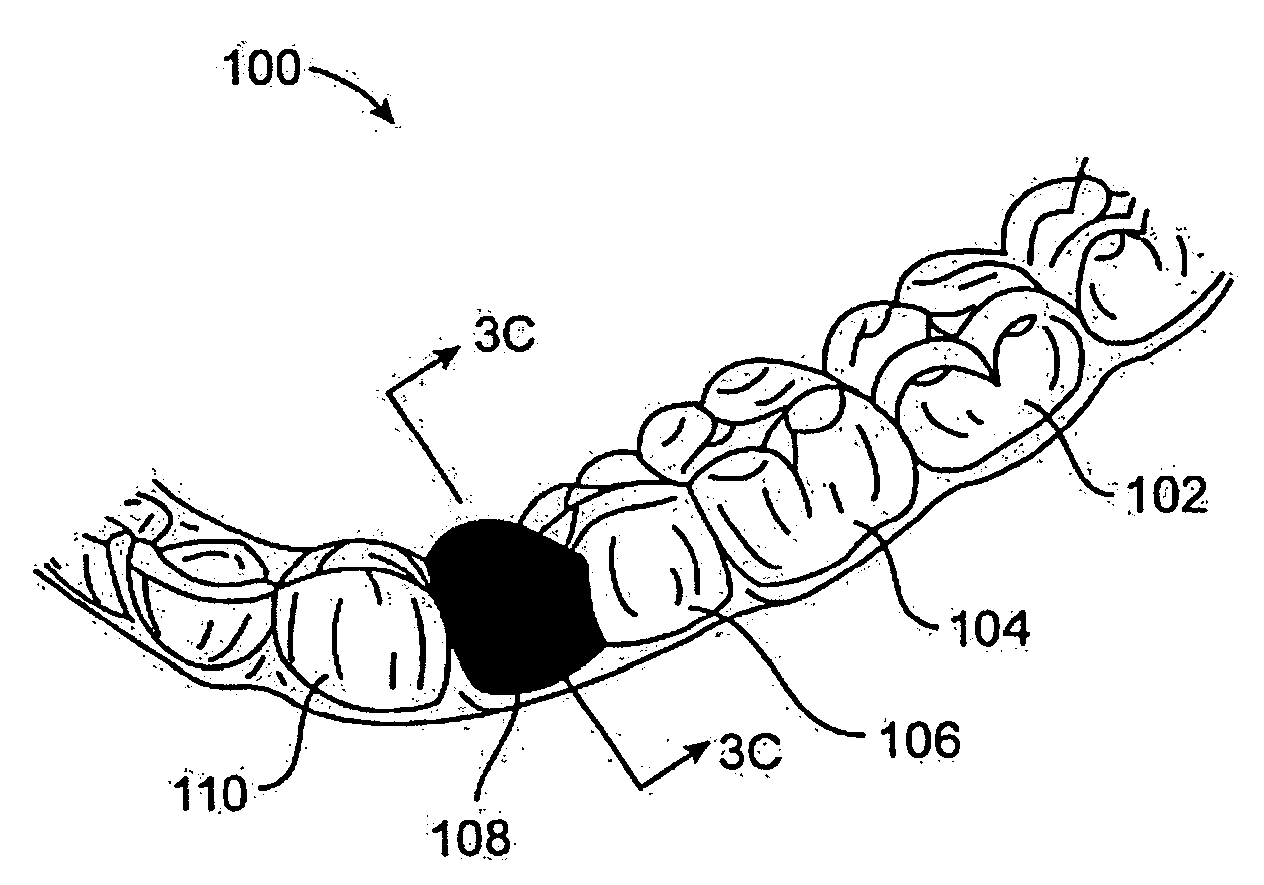 Method and kits for forming pontics in polymeric shell aligners