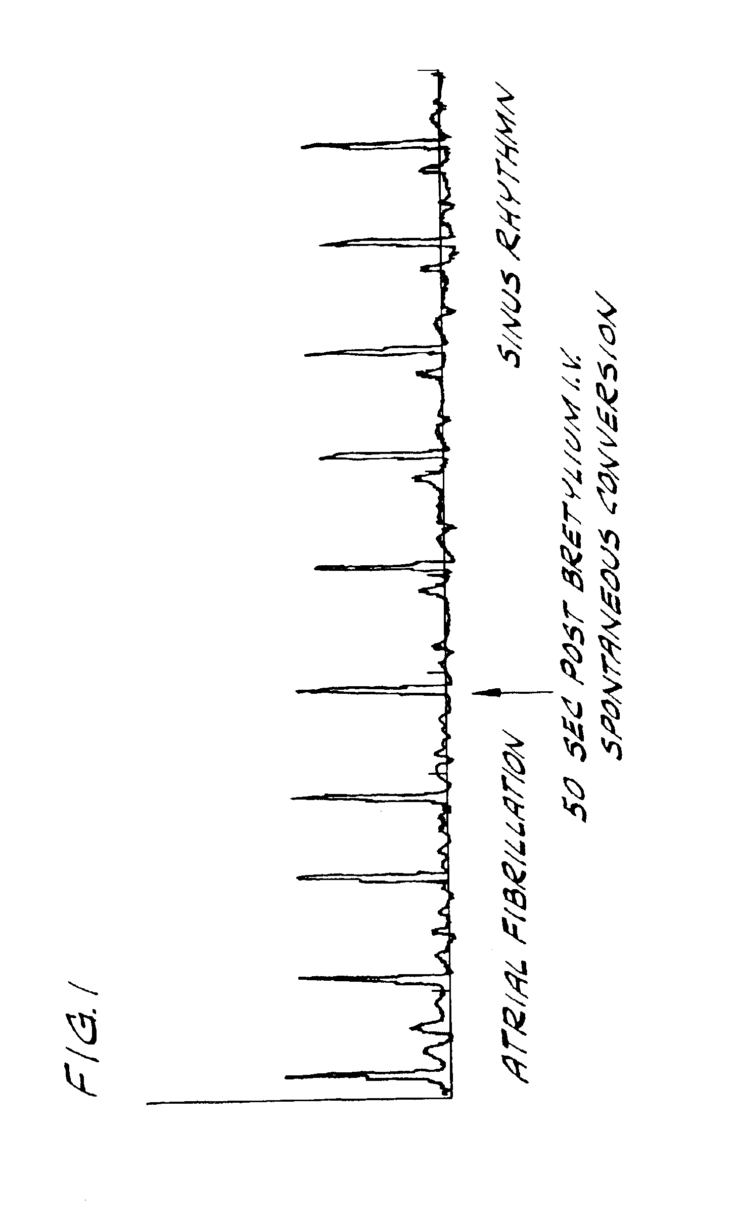 Bretylium compositions and kits and their use in preventing and treating cardiovascular conditions