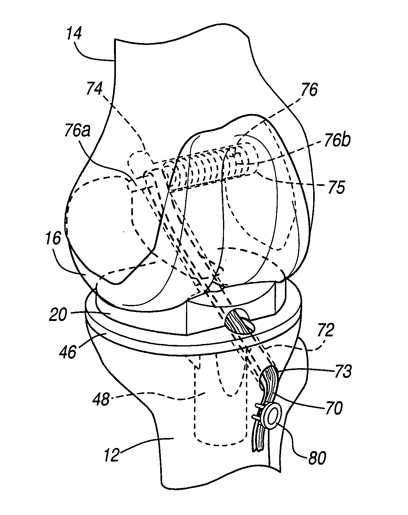 Knee prosthesis with graft ligaments