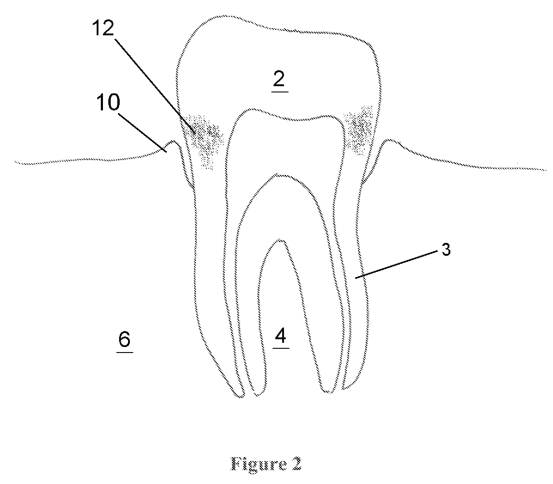 Method For Treating Periodontal Disease