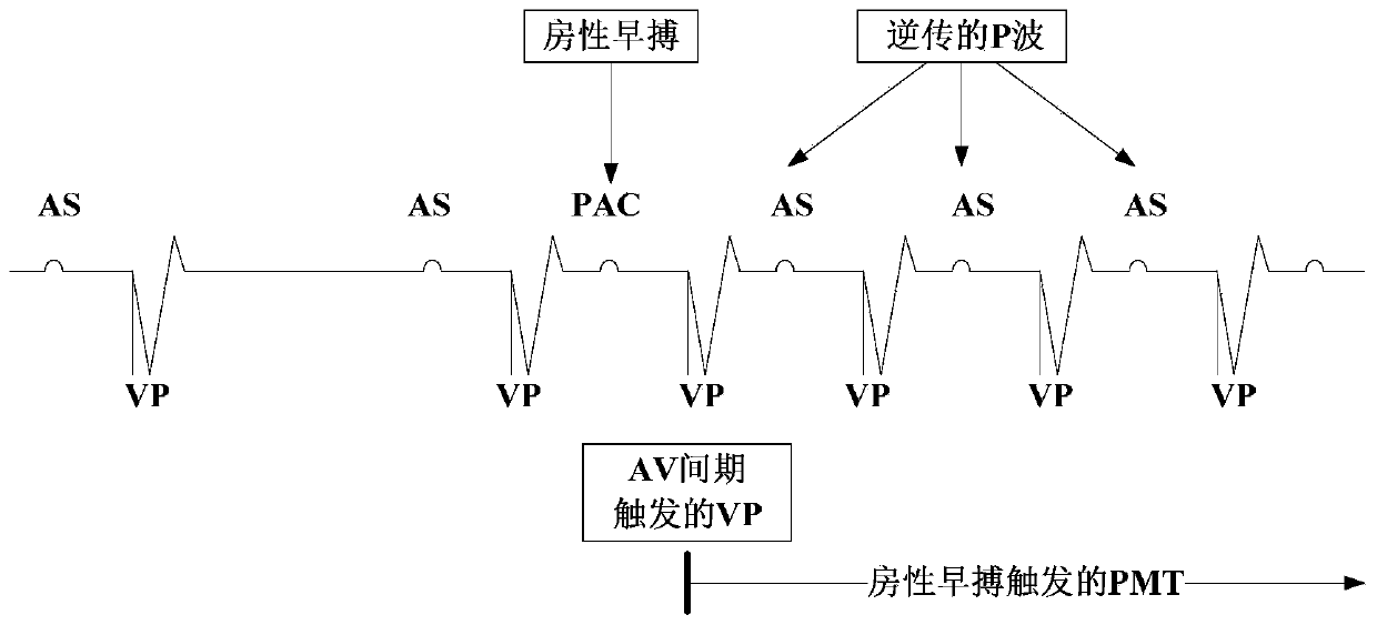 PMT inducement detection and prevention method, storage medium, and pacemaker system and device