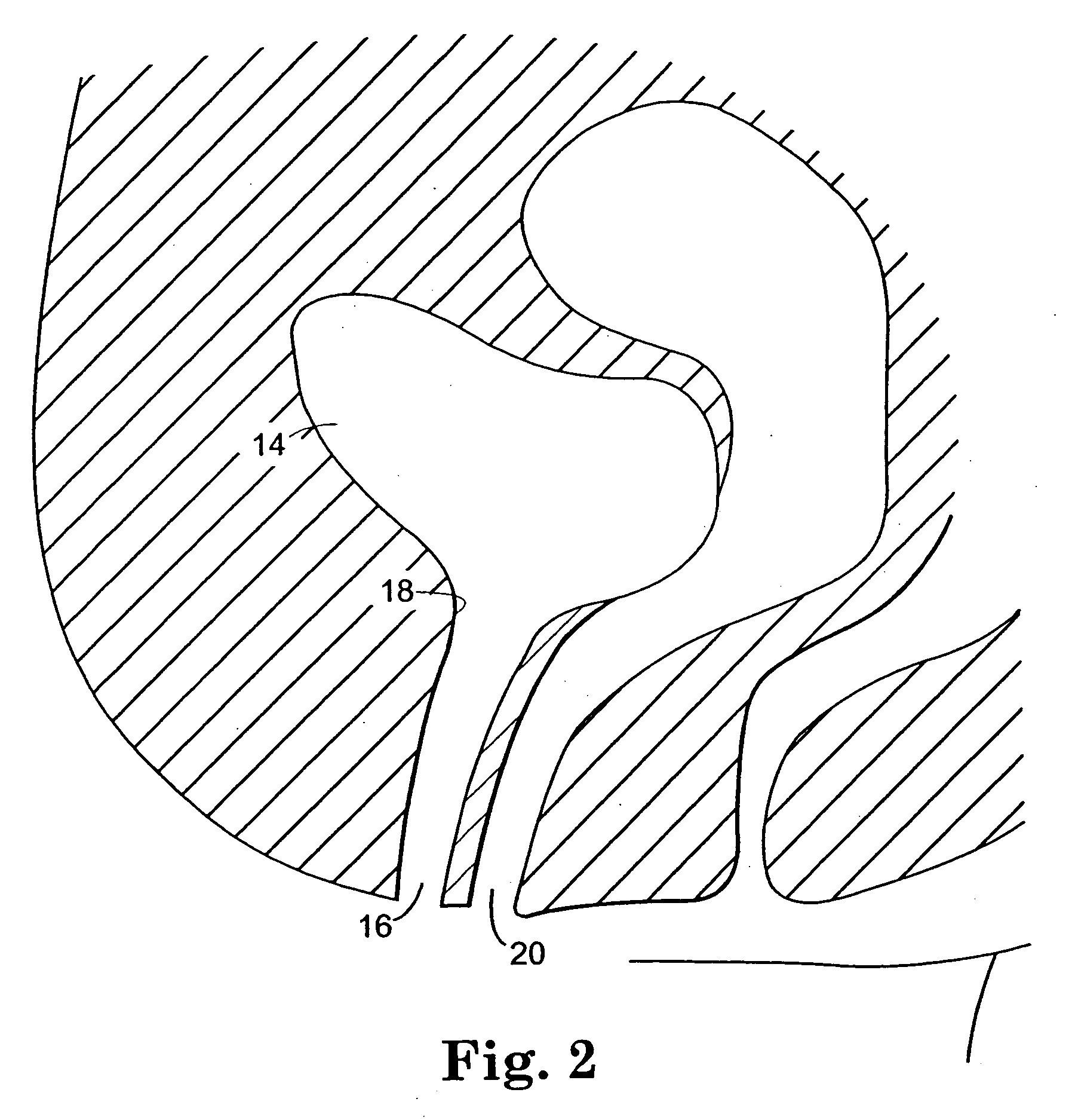 Sling delivery system and method of use