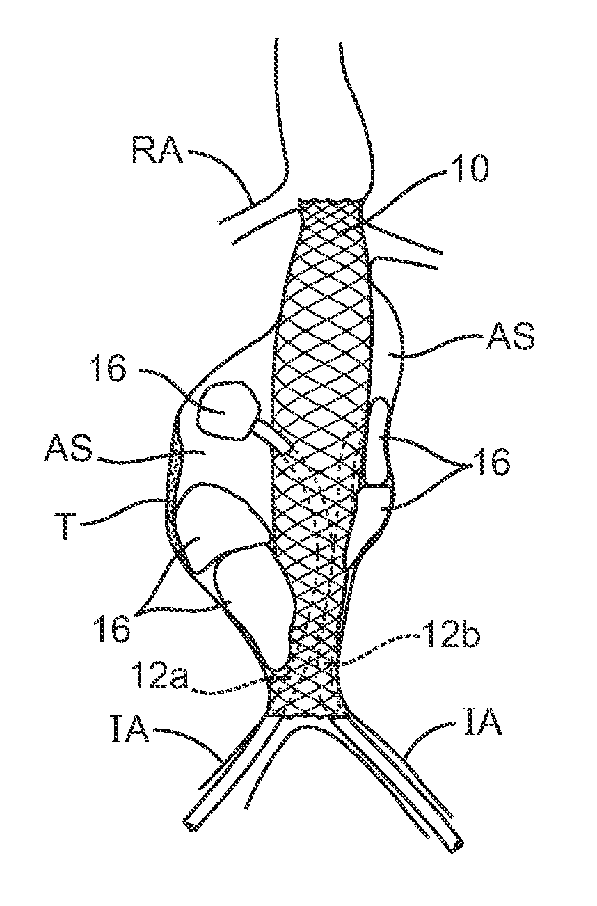 Methods and systems for aneurysm treatment using filling structures