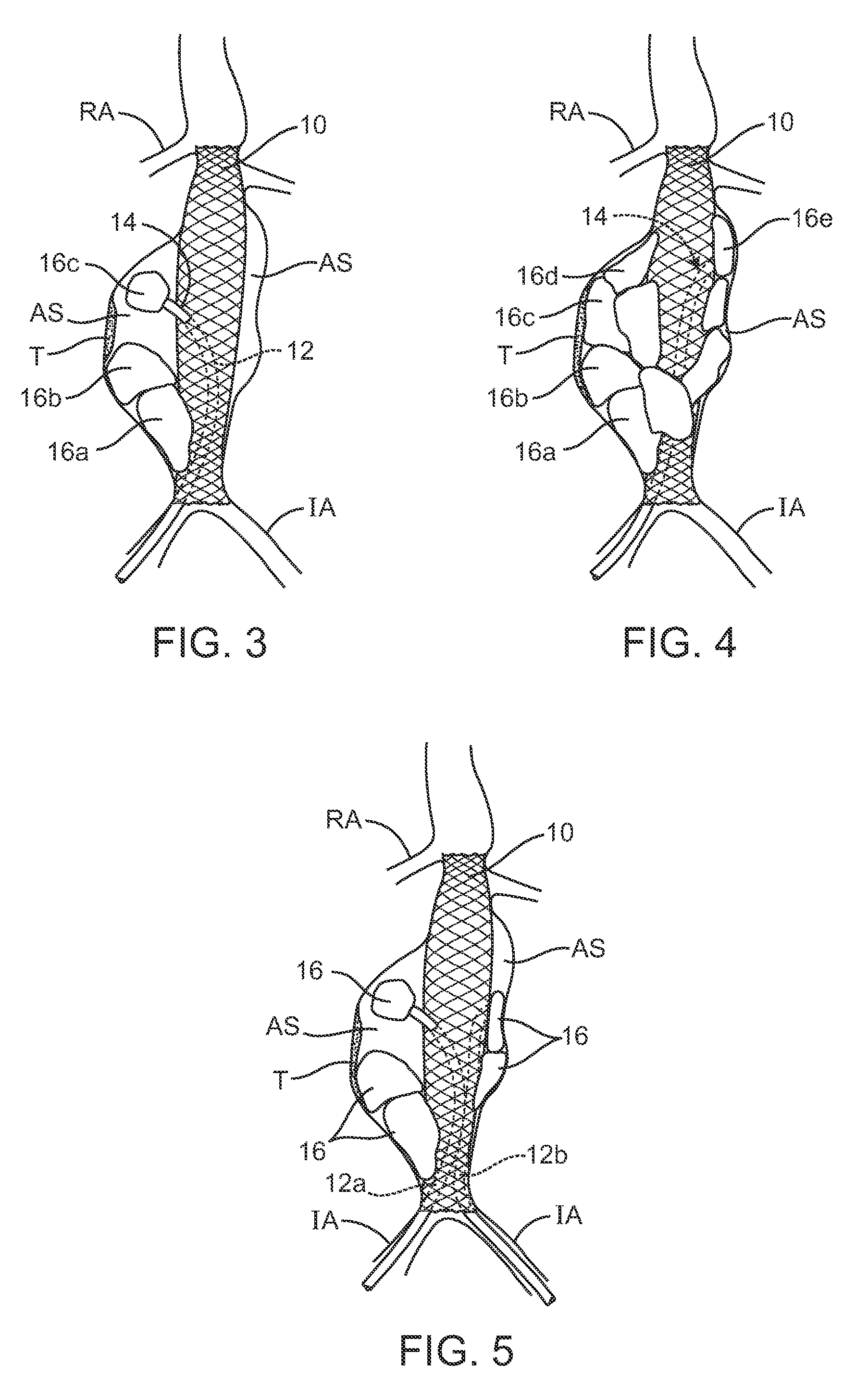 Methods and systems for aneurysm treatment using filling structures