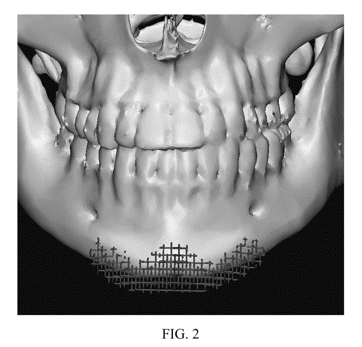 Osteoconductive and osteoinductive implant for augmentation, stabilization, or defect reconstruction