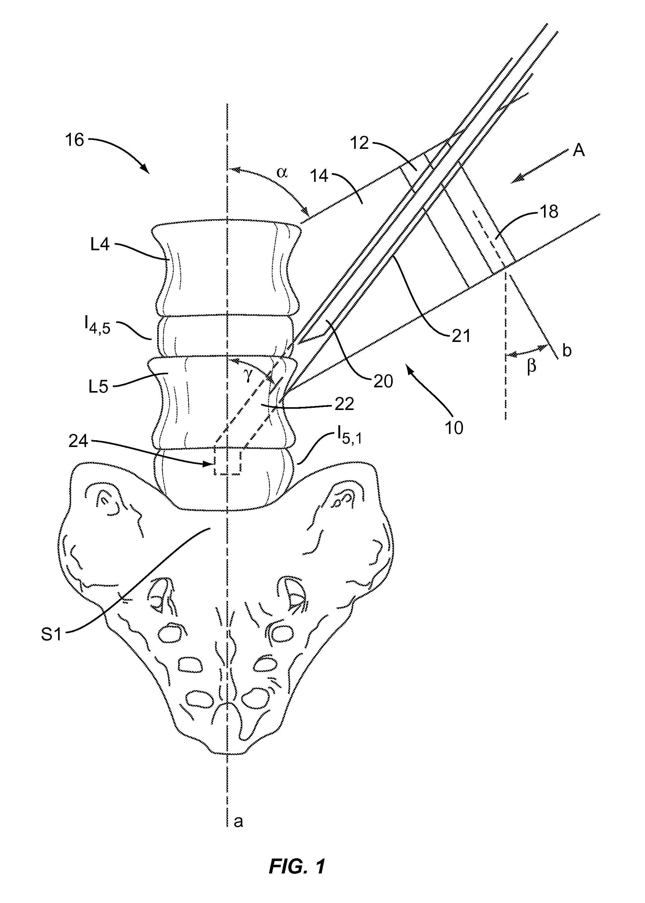 Lumbo-sacral implant system and method
