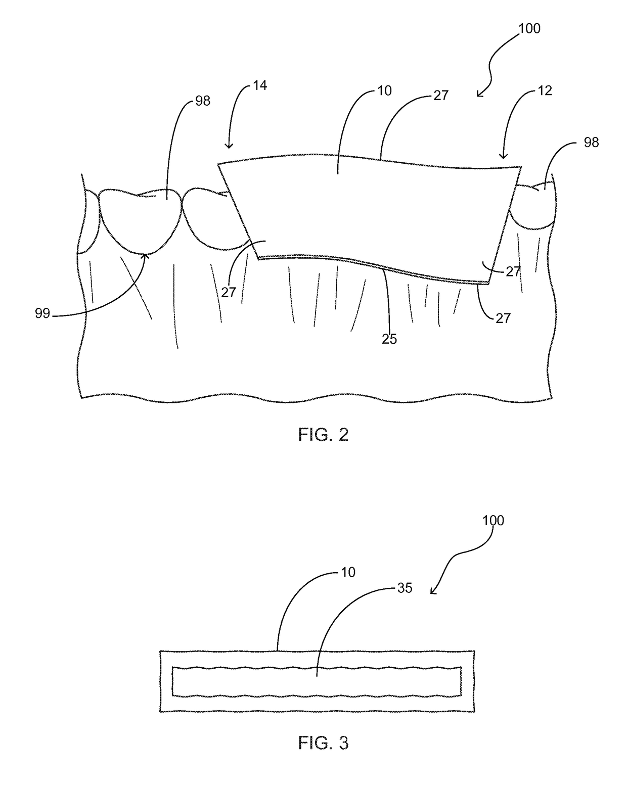 Tooth protection device