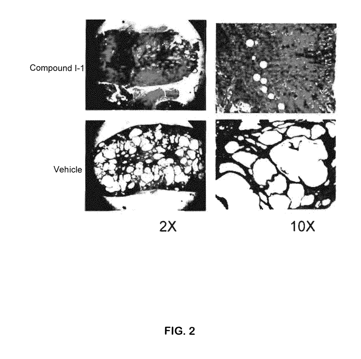 Methods for treating polycystic kidney disease and polycystic liver disease