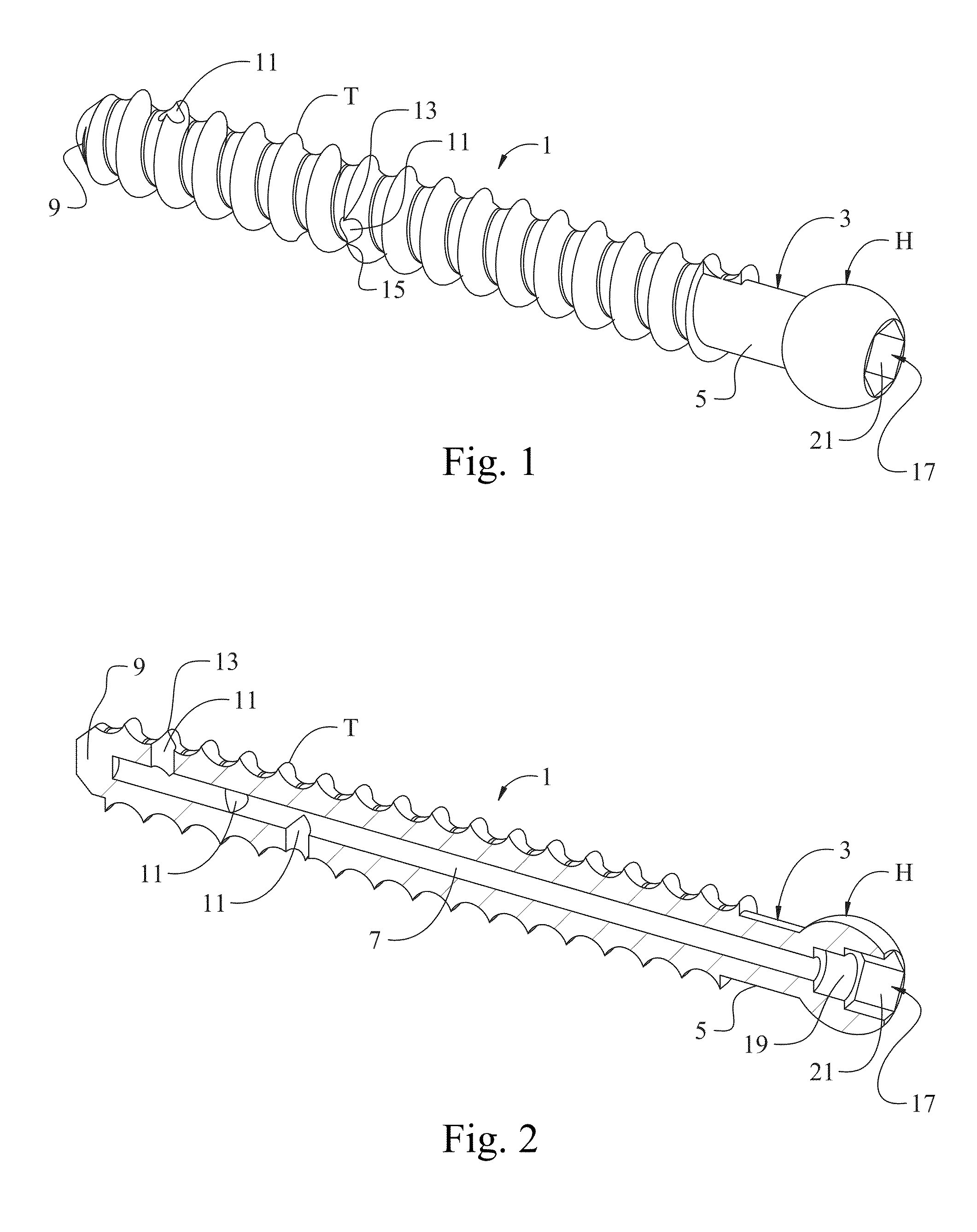 Fenestrated bone screw and method of injecting bone cement into bone structure