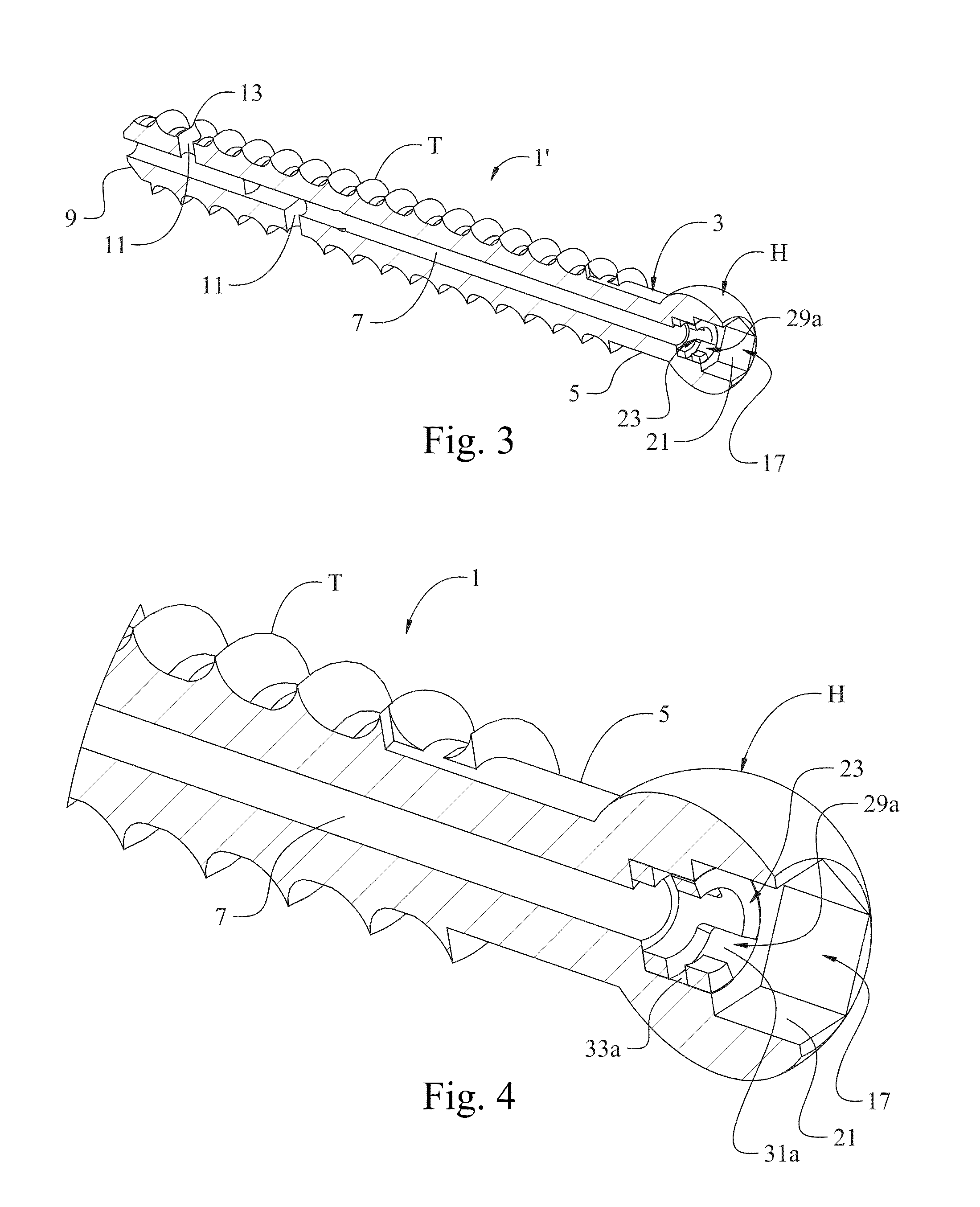 Fenestrated bone screw and method of injecting bone cement into bone structure